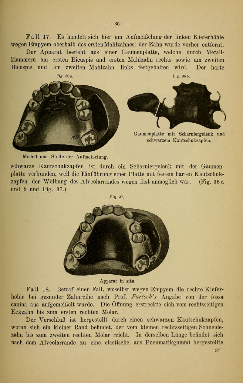Fall 17. Es handelt sich hier um Aufmeißelung-der linken Kieferhöhle wegen Empyem oberhalb des ersten Mahlzahnes; der Zahn wurde vorher entfernt. Der Apparat besteht aus einer Gaumenplatte, welche durch Metall- klammern am ersten Bicuspis und ersten Mahlzahn rechts sowie am zweiten Bicuspis und am zweiten Mahlzahn links festgehalten wird. Der harte Fig. 36 a. Fig. 36 b. G-aumenplatte mit Schamiergelenk und schwarzem Kautschukzapfen. Modell und Stelle der Aufmeißelung. schwarze Kautschukzapfen ist durch ein Scharniergelenk mit der Gaumen- platte verbunden, weil die Einführung einer Platte mit festem harten Kautschuk- zapfen der Wölbung des Alveolarrandes wegen fast unmöglich war. (Fig. 36 a und b und Fig. 37.) Fig. 37. Apparat in situ. Fall 18. Betraf einen Fall, woselbst wegen Empyem die rechte Kiefer- höhle bei gesunder Zahnreihe nach Prof. Partsch's Angabe von der fossa canina aus aufgemeißelt wurde. Die Öffnung erstreckte sich vom rechtsseitigen Eckzahn bis zum ersten rechten Molar. Der Verschluß ist hergestellt durch einen schwarzen Kautschukzapfen, woran sich ein kleiner Rand befindet, der vom kleinen rechtsseitigen Schneide- zahn bis zum zweiten rechten Molar reicht. In derselben Länge befindet sich nach dem Alveolarrande zu eine elastische, aus Pneumatikgummi hergestellte 3*