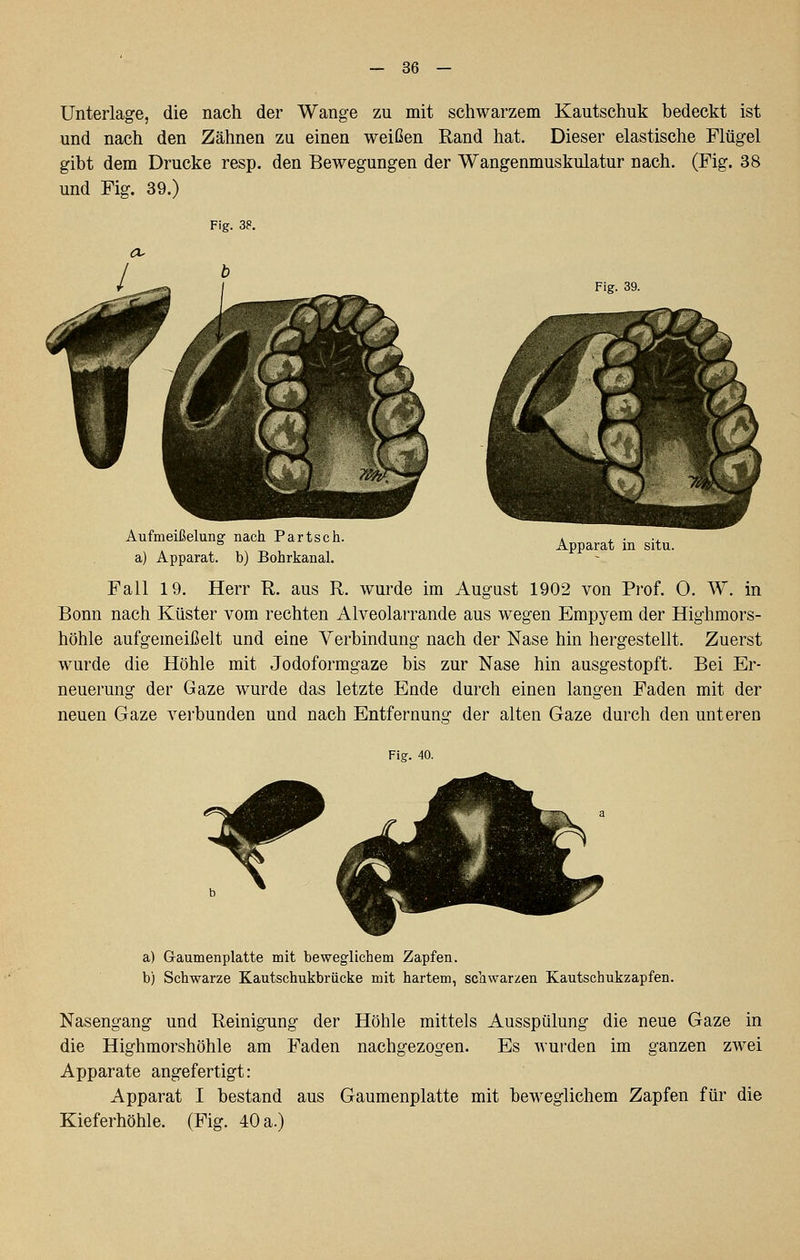 Unterlage, die nach der Wange zu mit schwarzem Kautschuk bedeckt ist und nach den Zähnen zu einen weißen Rand hat. Dieser elastische Flügel gibt dem Drucke resp. den Bewegungen der Wangenmuskulatur nach. (Fig. 38 und Fig. 39.) Fig. 39. Aufmeißelung nach Partsch. a) Apparat, b) Bohrkanal. Apparat in situ. Fall 19. Herr R. aus R. wurde im August 1902 von Prof. 0. W. in Bonn nach Küster vom rechten Alveolarrande aus wegen Empyem der Highmors- höhle aufgemeißelt und eine Verbindung nach der Nase hin hergestellt. Zuerst wurde die Höhle mit Jodoformgaze bis zur Nase hin ausgestopft. Bei Er- neuerung der Gaze wurde das letzte Ende durch einen langen Faden mit der neuen Gaze verbunden und nach Entfernung der alten Gaze durch den unteren Fig. 40. a) G-aumenplatte mit beweglichem Zapfen. b) Schwarze Kautschukbrücke mit hartem, schwarzen Kautschukzapfen. Nasengang und Reinigung der Höhle mittels Ausspülung die neue Gaze in die Highmorshöhle am Faden nachgezogen. Es wur-den im ganzen zwei Apparate angefertigt: Apparat I bestand aus Gaumenplatte mit beweglichem Zapfen für die Kieferhöhle. (Fig. 40 a.)