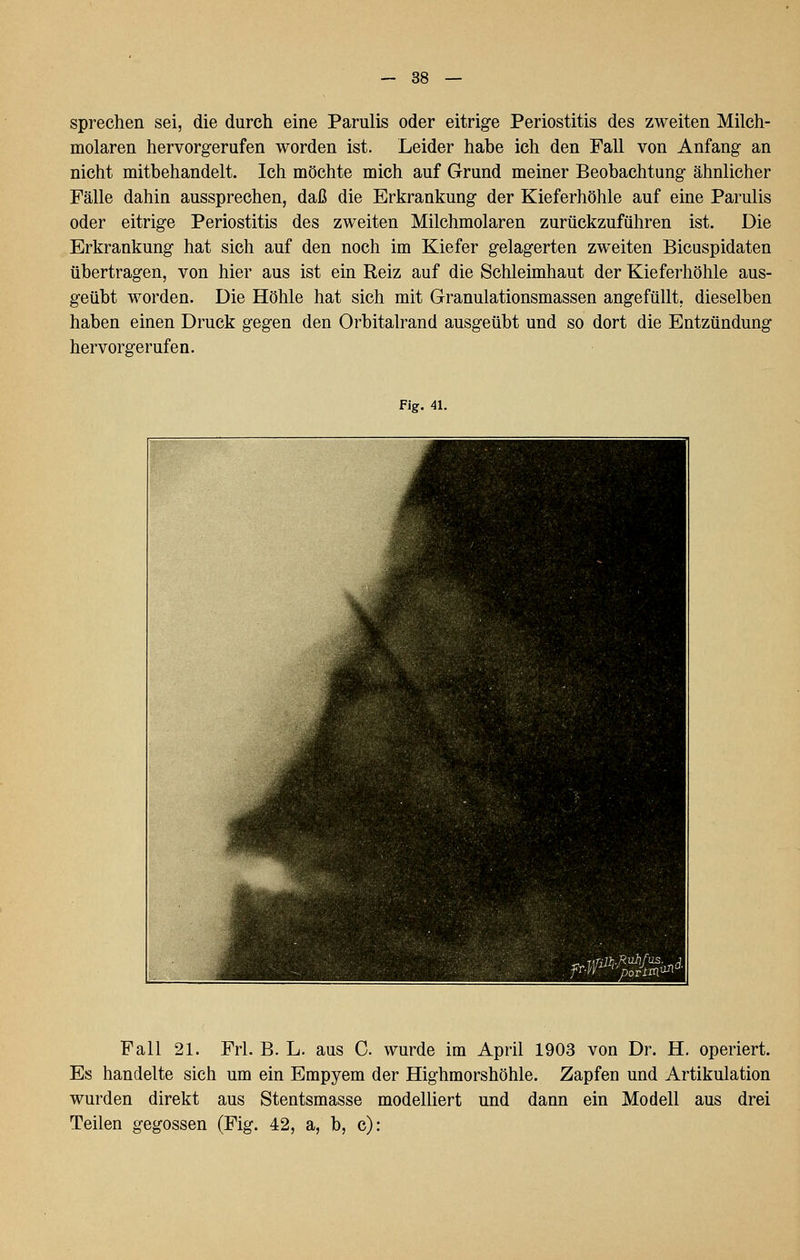 sprechen sei, die durch eine Parulis oder eitrige Periostitis des zweiten Milch- molaren hervorgerufen worden ist. Leider habe ich den Fall von Anfang an nicht mitbehandelt. Ich möchte mich auf Grund meiner Beobachtung ähnlicher Fälle dahin aussprechen, daß die Erkrankung der Kieferhöhle auf eine Parulis oder eitrige Periostitis des zweiten Milchmolaren zurückzuführen ist. Die Erkrankung hat sich auf den noch im Kiefer gelagerten zweiten Bicuspidaten übertragen, von hier aus ist ein Reiz auf die Schleimhaut der Kieferhöhle aus- geübt worden. Die Höhle hat sich mit Granulationsmassen angefüllt, dieselben haben einen Druck gegen den Orbitalrand ausgeübt und so dort die Entzündung hervorgerufen. Fig. 41. Fall 21. Frl. B. L. aus C wurde im April 1903 von Dr. H. operiert. Es handelte sich um ein Empyem der Highmorshöhle. Zapfen und Artikulation wurden direkt aus Stentsmasse modelliert und dann ein Modell aus drei Teilen gegossen (Fig. 42, a, b, c):