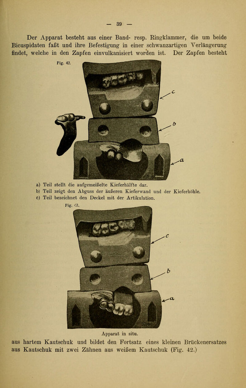 Der Apparat besteht aus einer Band- resp. Ringklammer, die um beide Bicuspidaten faßt und ihre Befestigung in einer schwanzartigen Verlängerung findet, welche in den Zapfen einvulkanisiert worden ist. Der Zapfen besteht Fig. 42 a) Teil stellt die aufgemeißelte Kieferhälfte dar. b) Teil zeigt den Abguss der äußeren Kieferwand und der Kieferhöhle. c) Teil bezeichnet den Deckel mit der Artikulation. Fig. ^3. Apparat in situ. aus hartem Kautschuk und bildet den Fortsatz eines kleinen Brückenersatzes aus Kautschuk mit zwei Zähnen aus weißem Kautschuk (Fig. 42.)