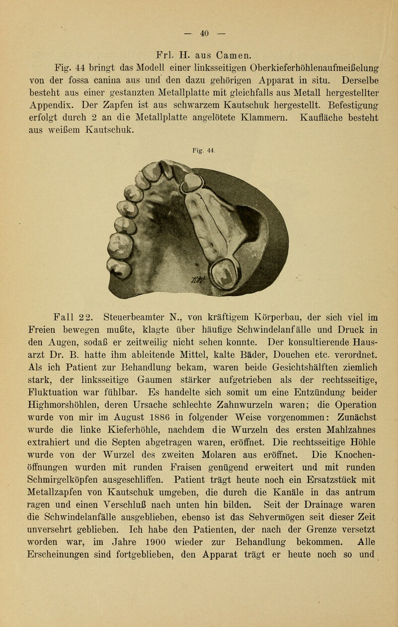 Frl. H. aus Camen. Fig. 44 bringt das Modell einer linksseitigen Oberkieferhöhlenaufmeißelung von der fossa canina aus und den dazu gehörigen Apparat in situ. Derselbe bestellt aus einer gestanzten Metallplatte mit gleichfalls aus Metall hergestellter Appendix. Der Zapfen ist aus schwarzem Kautschuk hergestellt. Befestigung erfolgt durch 2 an die Metallplatte angelötete Klammern. Kaufläche besteht aus weißem Kautschuk. Fig. 44. Fall 2 2. Steuerbeamter N., von kräftigem Körperbau, der sich viel im Freien bewegen mußte, klagte über häufige Schwindelanfälle und Druck in den Augen, sodaß er zeitweilig nicht sehen konnte. Der konsultierende Haus- arzt Dr. B. hatte ihm ableitende Mittel, kalte Bäder, Douchen etc. verordnet. Als ich Patient zur Behandlung bekam, waren beide Gesichtshälften ziemlich stark, der linksseitige Gaumen stärker aufgetrieben als der rechtsseitige, Fluktuation war fühlbar. Es handelte sich somit um eine Entzündung beider Highmorshöhlen, deren Ursache schlechte Zahnwurzeln waren; die Operation wurde von mir im August 1886 in folgender Weise vorgenommen: Zunächst wurde die linke Kieferhöhle, nachdem die Wurzeln des ersten Mahlzahnes extrahiert und die Septen abgetragen waren, eröffnet. Die rechtsseitige Höhle wurde von der Wurzel des zweiten Molaren aus eröffnet. Die Knochen- öffnungen wurden mit runden Fraisen genügend erweitert und mit runden Schmirgelköpfen ausgeschliffen. Patient trägt heute noch ein Ersatzstück mit Metallzapfen von Kautschuk umgeben, die durch die Kanäle in das antrum ragen und einen Verschluß nach unten hin bilden. Seit der Drainage waren die Schwindelanfälle ausgeblieben, ebenso ist das Sehvermögen seit dieser Zeit unversehrt geblieben. Ich habe den Patienten, der nach der Grenze versetzt worden war, im Jahre 1900 wieder zur Behandlung bekommen. Alle Erscheinungen sind fortgeblieben, den Apparat trägt er heute noch so und