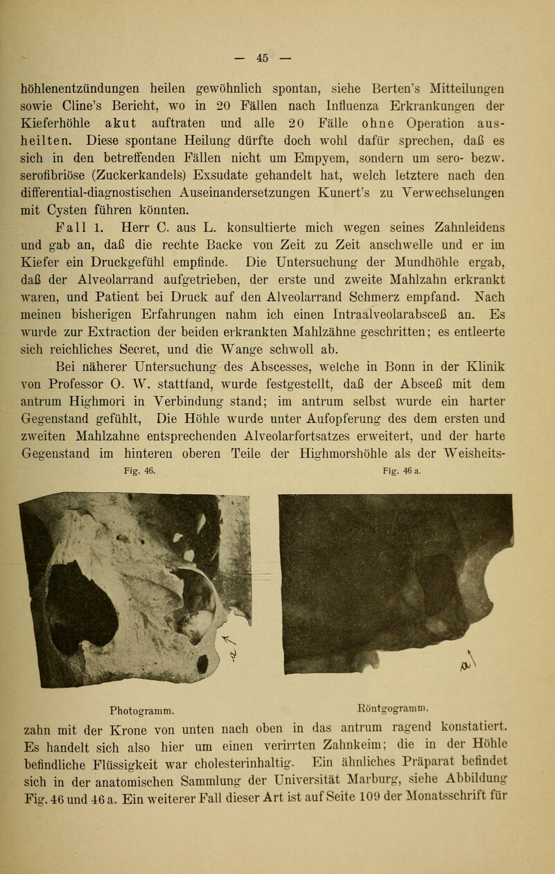 höhlenentzündungen heilen gewöhnlich spontan, siehe Berten's Mitteilungen sowie Cline's Bericht, wo in 20 Fällen nach Influenza Erkrankungen der Kieferhöhle akut auftraten und alle 20 Fälle ohne Operation aus- heilten. Diese spontane Heilung dürfte doch wohl dafür sprechen, daß es sich in den betreffenden Fällen nicht um Empyem, sondern um sero- bezw. seroflbriöse (Zuckerkandeis) Exsudate gehandelt hat, welch letztere nach den differential-diagnostischen Auseinandersetzungen Kunert's zu Verwechselungen mit Cysten führen könnten. Fall 1. Herr C. aus L. konsultierte mich wegen seines Zahnleidens und gab an, daß die rechte Backe von Zeit zu Zeit anschwelle und er im Kiefer ein Druckgefühl empfinde. Die Untersuchung der Mundhöhle ergab, daß der Alveolarrand aufgetrieben, der erste und zweite Mahlzahn erkrankt waren, und Patient bei Druck auf den Alveolarrand Schmerz empfand. Nach meinen bisherigen Erfahrungen nahm ich einen Intraalveolarabsceß an. Es wur'de zur Extraction der beiden erkrankten Mahlzähne geschritten; es entleerte sich reichliches 8ecret, und die Wange schwoll ab. Bei näherer Untersuchung des Abscesses, welche in Bonn in der Klinik von Professor 0. W. stattfand, wurde festgestellt, daß der Absceß mit dem antrum Highmori in Verbindung stand; im antrum selbst wurde ein harter Gegenstand gefühlt. Die Höhle wurde unter Aufopferung des dem ersten und zweiten Mahlzahne entsprechenden Alveolarfortsatzes erweitert, und der harte Gegenstand im hinteren oberen Teile der Highmorshöhle als der Weisheits- Fig. 46. Fig. 46 a. Photogramm. Röntgogramm. zahn mit der Krone von unten nach oben in das antrum ragend konstatiert. Es handelt sich also hier um einen verirrten Zahnkeim; die in der Höhle befindliche Flüssigkeit war cholesterinhaltig. Ein ähnliches Präparat befindet sich in der anatomischen Sammlung der Universität Marburg, siehe Abbildung Fig. 46 und 46 a. Ein weiterer Fall dieser Art ist auf Seite 109 der Monatsschrift für