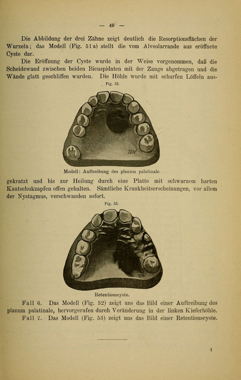 — 49 — Die Abbildung der drei Zähne zeigt deutlich die Resorptionsflächen der Wurzeln; das Modell (Fig. 51a) stellt die vom Alveolarrande aus eröffnete Cyste dar. Die Eröffnung der Cyste wurde in der Weise vorgenommen, daß die Scheidewand zwischen beiden Bicuspidaten mit der Zange abgetragen und die Wände glatt geschliffen wurden. Die Höhle wurde mit scharfen Löffeln aus- . Fig. 52. Modell: Auftreibung des planum palatinale. gekratzt und bis zur Heilung durch eine Platte mit schwarzem harten Kautschukzapfen offen gehalten. Sämtliche Krankheitserscheinungen, vor allem der Nystagmus, verschwanden sofort. Fig. 53. Retentionscyste. Fall 6. Das Modell (Fig. 52) zeigt uns das Bild einer Auftreibung des planum palatinale, hervorgerufen durch Veränderung in der linken Kieferhöhle.