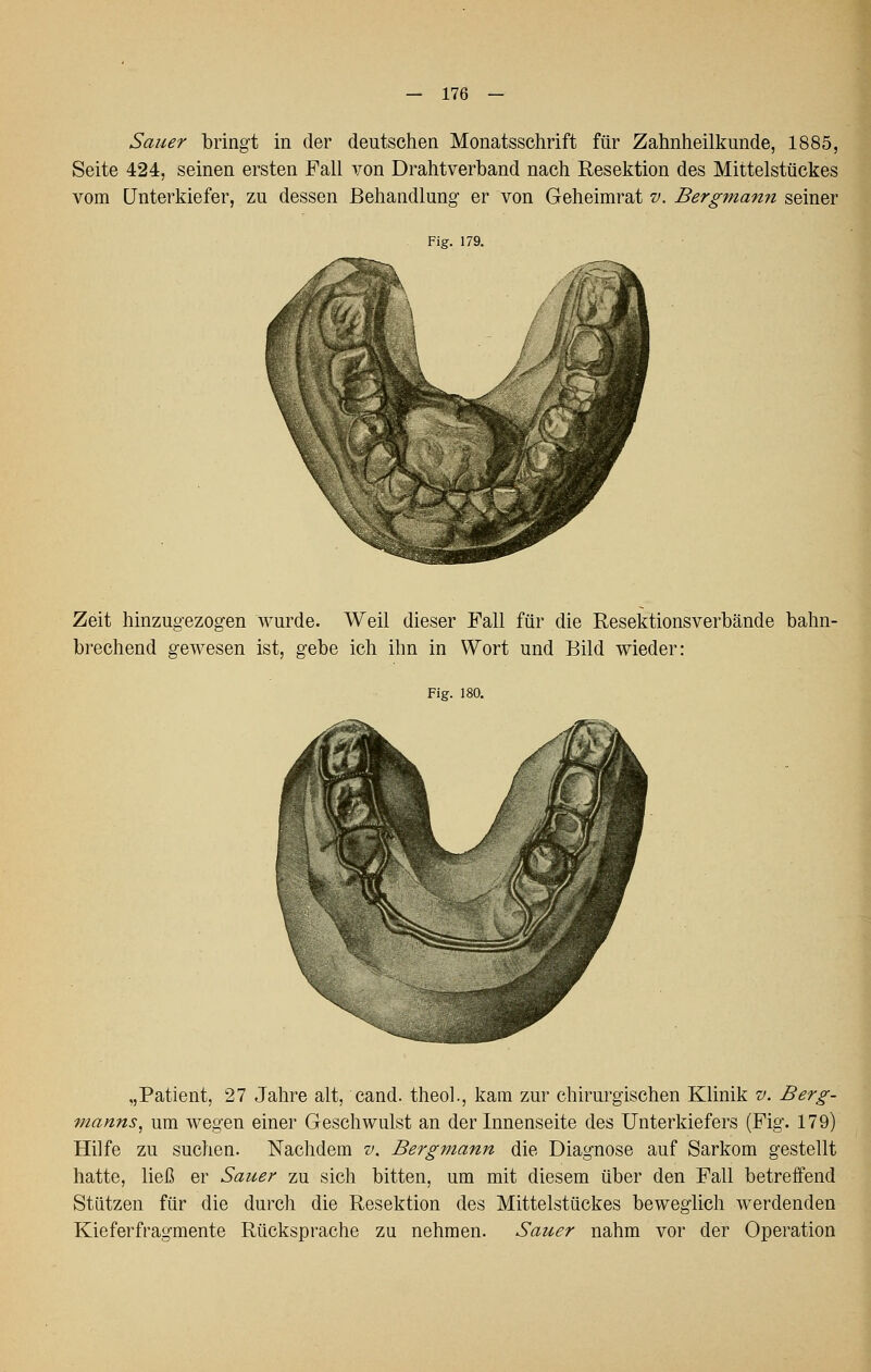 Sauer bringt in der deutschen Monatsschrift für Zahnheilkunde, 1885, Seite 424, seinen ersten Fall von Drahtverband nach Resektion des Mittelstückes vom Unterkiefer, zu dessen Behandlung er von Geheimrat v. Bergmann seiner Fig. 179. Zeit hinzugezogen wurde. Weil dieser Fall für die Resektionsverbände bahn- brechend gewesen ist, gebe ich ihn in Wort und Bild wieder: Fig. 180. „Patient, 27 Jahre alt, cand. theol., kam zur chirurgischen Klinik v. Berg- manns^ um wegen einer Geschwulst an der Innenseite des Unterkiefers (Fig. 179) Hilfe zu suchen. Nachdem v. Bergmann die Diagnose auf Sarkom gestellt hatte, ließ er Sauer zu sich bitten, um mit diesem über den Fall betreffend Stützen für die durch die Resektion des Mittelstückes beweglich werdenden Kieferfragmente Rücksprache zu nehmen. Sauer nahm vor der Operation