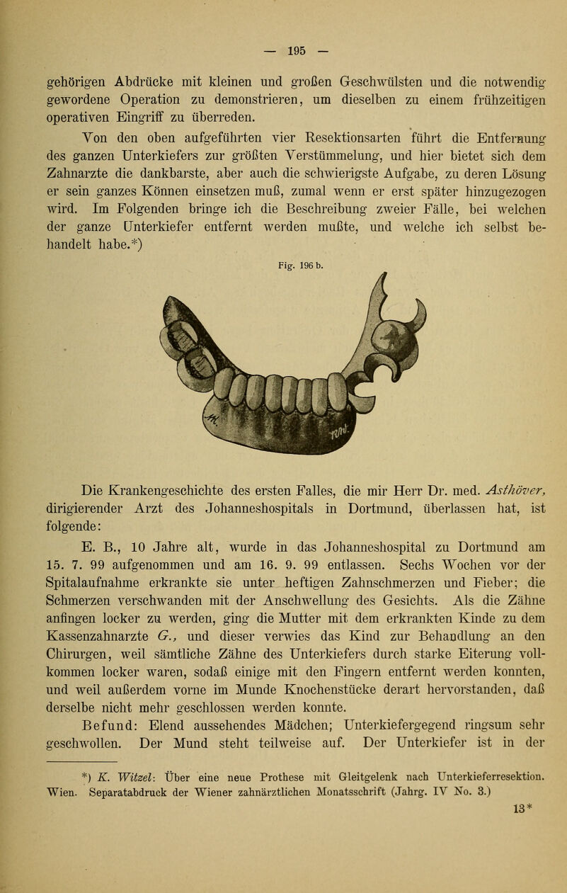 gehörigen Abdrücke mit kleinen und großen Geschwülsten und die notwendig gewordene Operation zu demonstrieren, um dieselben zu einem frühzeitigen operativen Eingriff zu überreden. Von den oben aufgeführten vier Resektionsarten führt die Entfernung des ganzen Unterkiefers zur größten Verstümmelung, und hier bietet sich dem Zahnarzte die dankbarste, aber auch die schwierigste Aufgabe, zu deren Lösung er sein ganzes Können einsetzen muß, zumal wenn er erst später hinzugezogen wird. Im Folgenden bringe ich die Beschreibung zweier Fälle, bei welchen der ganze Unterkiefer entfernt werden mußte, und welche ich selbst be- handelt habe.*) Fig. 196 b. Die Krankengeschichte des ersten Falles, die mir Herr Dr. med. Asthöver, dirigierender Arzt des Johanneshospitals in Dortmund, überlassen hat, ist folgende: E. B., 10 Jahre alt, wurde in das Johanneshospital zu Dortmund am 15. 7. 99 aufgenommen und am 16. 9. 99 entlassen. Sechs Wochen vor der Spitalaufnahme erkrankte sie unter heftigen Zahnschmerzen und Fieber; die Schmerzen verschwanden mit der Anschwellung des Gesichts. Als die Zähne anfingen locker zu werden, ging die Mutter mit dem erkrankten Kinde zu dem Kassenzahnarzte G., und dieser verwies das Kind zur Behandlung an den Chirurgen, weil sämtliche Zähne des Unterkiefers durch starke Eiterung voll- kommen locker waren, sodaß einige mit den Fingern entfernt werden konnten, und weil außerdem vorne im Munde Knochenstücke derart hervorstanden, daß derselbe nicht mehr geschlossen werden konnte. Befund: Elend aussehendes Mädchen; Unterkiefergegend ringsum sehr geschwollen. Der Mund steht teilweise auf. Der Unterkiefer ist in der *) K. Witzel: Über eine neue Prothese mit Gleitgelenk nach Unterkieferresektion. Wien. Separatabdruck der Wiener zahnärztlichen Monatsschrift (Jahrg. IV No. 3.) 13*