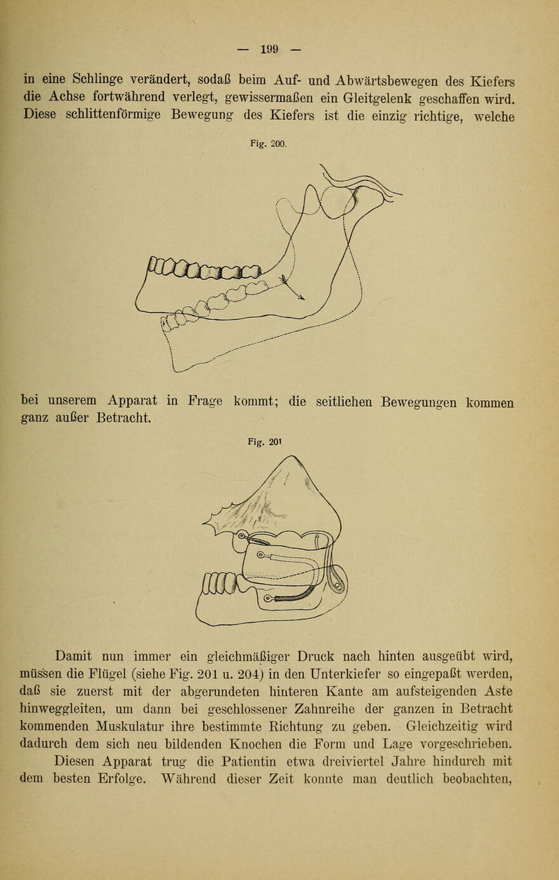 in eine Schlinge verändert, sodaß beim Auf- und Abwärtsbewegen des Kiefers die Achse fortwährend verlegt, gewissermaßen ein Gleitgelenk geschaffen wird. Diese schlittenförmige Bewegung des Kiefers ist die einzig richtige, welche Fig. 200. bei unserem Apparat in Frage kommt; die seitlichen Bewegungen kommen ganz außer Betracht. Fig. 201 Damit nun immer ein gleichmäßiger Druck nach hinten ausgeübt wird, müssen die Flügel (siehe Fig. 201 u. 204) in den Unterkiefer so eingepaßt werden, daß sie zuerst mit der abgerundeten hinteren Kante am aufsteigenden Aste hinweggleiten, um dann bei geschlossener Zahnreihe der ganzen in Betracht kommenden Muskulatur ihre bestimmte Richtung zu geben. Gleichzeitig wird dadurch dem sich neu bildenden Knochen die Form und Lage vorgeschrieben. Diesen Apparat trug die Patientin etwa dreiviertel Jahre hindurch mit dem besten Erfolge. Während dieser Zeit konnte man deutlich beobachten,