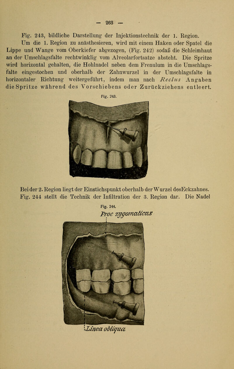 Fig-. 243, bildliche Darstellung der Injektionstechnik der 1. Region. Um die 1. Region zu anästhesieren, wird mit einem Haken oder Spatel die Lippe und Wange vom Oberkiefer abgezogen, (Fig. 242) sodaß die Schleimhaut an der Umschlagsfalte rechtwinklig vom Alveolarfortsatze absteht. Die Spritze wird horizontal gehalten, die Hohlnadel neben dem Frenulum in die Umschlags- falte eingestochen und oberhalb der Zahnwurzel in der Umschlags falte in horizontaler Richtung weitergeführt, indem man nach Reclus Angaben die Spritze während des Vorschiebens oder Zurückziehens entleert. Fig. 243. Bei der 2. Region liegt der Einstichspunkt oberhalb der Wurzel desEckzahnes. Fig. 244 stellt die Technik der Infiltration der 3. Region dar. Die Nadel Fig. 244. \,Linea obli^ua