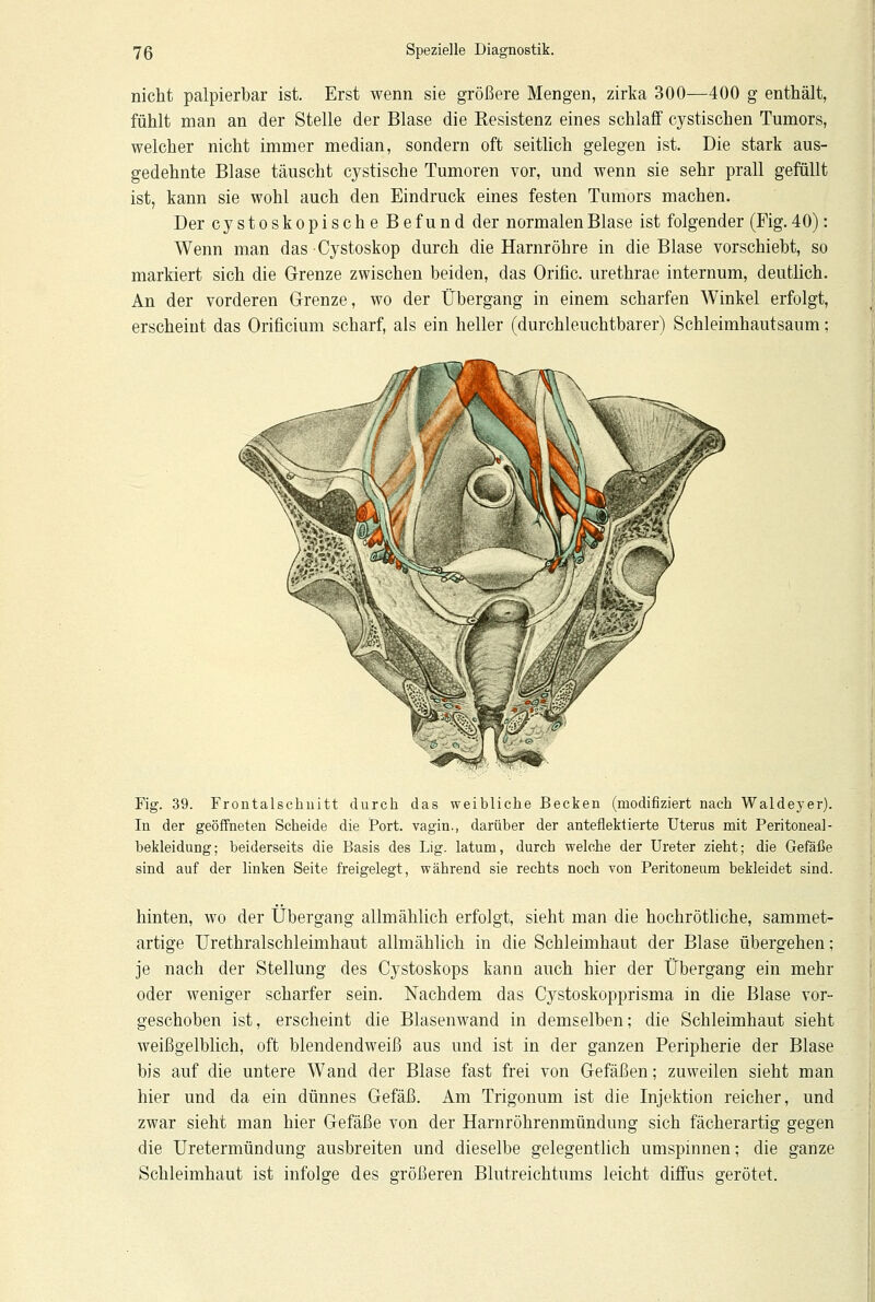 nicht palpierbar ist. Erst wenn sie größere Mengen, zirka 300—400 g enthält, fühlt man an der Stelle der Blase die Resistenz eines schlaff cystischen Tumors, welcher nicht immer median, sondern oft seitlich gelegen ist. Die stark aus- gedehnte Blase täuscht cystische Tumoren vor, und wenn sie sehr prall gefüllt ist, kann sie wohl auch den Eindruck eines festen Tumors machen. Der cystoskopische Befund der normalen Blase ist folgender (Fig. 40): Wenn man das •Cystoskop durch die Harnröhre in die Blase vorschiebt, so markiert sich die Grenze zwischen beiden, das Orific. urethrae internum, deutlich. An der vorderen Grenze, wo der Übergang in einem scharfen Winkel erfolgt, erscheint das Orificium scharf, als ein heller (durchleuchtbarer) Schleimhautsanm; Fig. 39. Frontalschuitt durch das weibliche Becken (modifiziert nach Waldeyer). In der geöffneten Scheide die Port, vagin., darüber der anteflektierte Uterus mit Peritoneal- bekleidung; beiderseits die Basis des Lig. latum, durch welche der Ureter zieht; die Gefäße sind auf der linken Seite freigelegt, während sie rechts noch von Peritoneum bekleidet sind. hinten, wo der Übergang allmählich erfolgt, sieht man die hochrötliche, sammet- artige Urethralschleimhaut allmählich in die Schleimhaut der Blase übergehen; je nach der Stellung des Cystoskops kann auch hier der Übergang ein mehr oder weniger scharfer sein. Nachdem das Cystoskopprisma in die Blase vor- geschoben ist, erscheint die Blasenwand in demselben; die Schleimhaut sieht weißgelblich, oft blendendweiß aus und ist in der ganzen Peripherie der Blase bis auf die untere Wand der Blase fast frei von Gefäßen; zuweilen sieht man hier und da ein dünnes Gefäß. Am Trigonum ist die Injektion reicher, und zwar sieht man hier Gefäße von der Harnröhrenmündung sich fächerartig gegen die Uretermündung ausbreiten und dieselbe gelegentlich umspinnen; die ganze Schleimhaut ist infolge des größeren Blutreichtums leicht diffus gerötet.