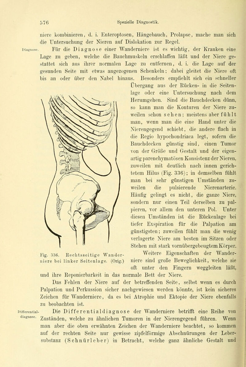 niere kombinieren, d. i. Enteroptosen, Hängebauch, Prolapse, mache man sich die Untersuchung der Nieren auf Dislokation zur Regel. Diagnose. Für die Diagnose einer Wanderniere ist es wichtig, der Kranken eine Lage zu geben, welche die Bauchmuskeln erschlaffen läßt und der Niere ge- stattet sich aus ihrer normalen Lage zu entfernen, d. i. die Lage auf der gesunden Seite mit etwas angezogenen Schenkeln; dabei gleitet die Niere oft bis an oder über den Nabel hinaus. Besonders empfiehlt sich ein schneller Übergang aus der Rücken- in die Seiten- lage oder eine Untersuchung nach dem Herumgehen. Sind die Bauchdecken dünn, so kann man die Konturen der Niere zu- weilen schon sehen; meistens aber fühlt man, wenn man die eine Hand unter die Nierengegend schiebt, die andere flach in die Regio hypochondriaca legt, sofern die Bauchdecken günstig sind, einen Tumor von der Größe und Gestalt und der eigen- artig parenchymatösen Konsistenz der Nieren, zuweilen mit deutlich nach innen gerich- tetem Hilus (Fig. 336); in demselben fühlt man bei sehr günstigen Umständen zu- weilen die pulsierende Nierenarterie. Häufig gelingt es nicht, die ganze Niere, sondern nur einen Teil derselben zu pal- pieren, vor allem den unteren Pol. Unter diesen Umständen ist die Rückenlage bei tiefer Exspiration für die Palpation am günstigsten; zuweilen fühlt man die wenig verlagerte Niere am besten im Sitzen oder Stehen mit stark vornübergebeugtem Körper. Weitere Eigenschaften der Wander- niere sind große Beweglichkeit, welche sie oft unter den Fingern weggleiten läßt, und ihre Reponierbarkeit in das normale Bett der Niere. Das Fehlen der Niere auf der betreffenden Seite, selbst wenn es durch Palpation und Perkussion sicher nachgewiesen werden könnte, ist kein sicheres Zeichen für Wanderniere, da es bei Atrophie und Ektopie der Niere ebenfalls zu beobachten ist. Differential- Die D if f e r e n t i a 1 d i a g n o s e der Wanderniere betrifft eine Reihe von diagnose. Zuständen, welche zu ähnlichen Tumoren in der Nierengegend führen. Wenn man aber die oben erwähnten Zeichen der Wanderniere beachtet, so kommen auf der rechten Seite nur gewisse zipfelförmige Abschnürungen der Leber- substanz (Schnürleber) in Betracht, welche ganz ähnliche Gestalt und Fig. 336. Eechtsseitige Wander- niere bei linker Seitenlage. (Orig.)