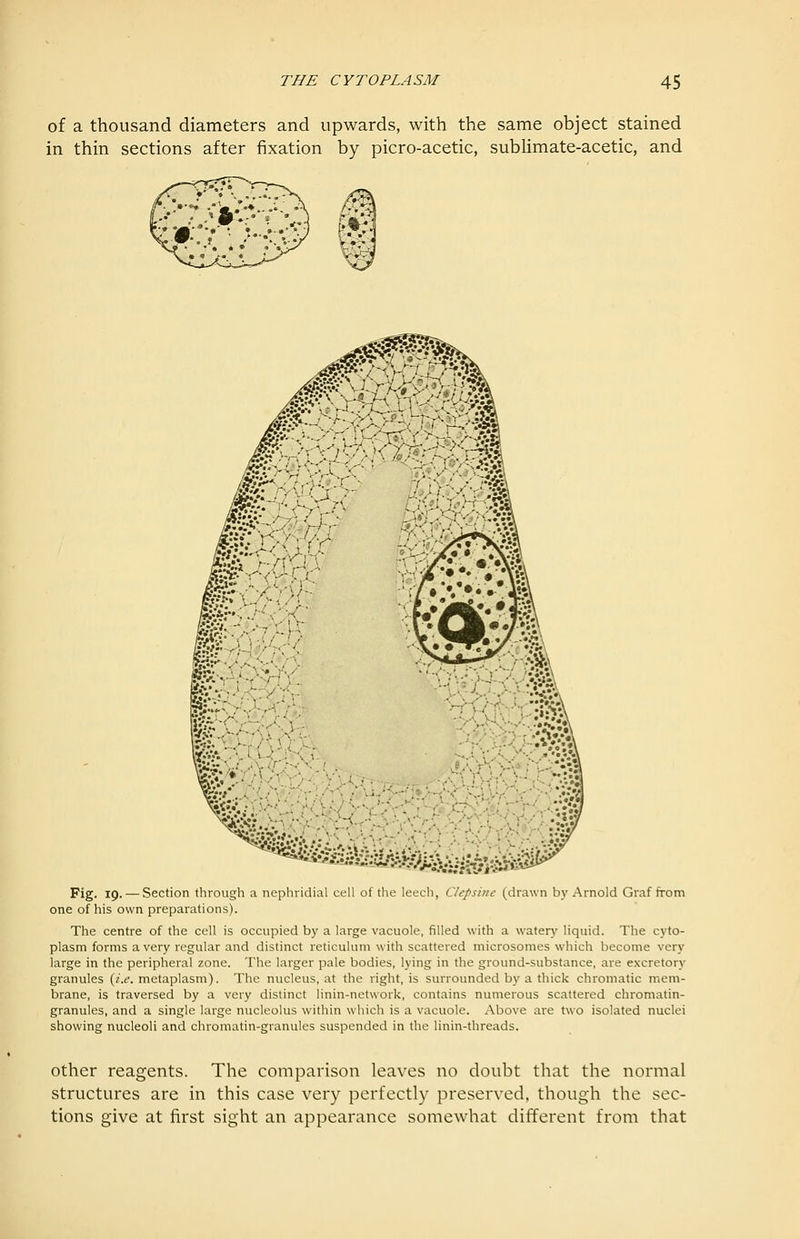 of a thousand diameters and upwards, with the same object stained in thin sections after fixation by picro-acetic, sublimate-acetic, and Fig. 19. — Section through a nephridial cell of the leech, C/epsiiic (drawn by Arnold Graf from one of his own preparations). The centre of the cell is occupied by a large vacuole, filled with a watery liquid. The cyto- plasm forms a very regular and distinct reticulum with scattered microsomes which become very large in the peripheral zone. The larger pale bodies, lying in the ground-substance, are excretory granules {i.e. metaplasm). The nucleus, at the right, is surrounded by a thick chromatic mem- brane, is traversed by a very distinct linin-network, contains numerous scattered chromatin- granules, and a single large nucleolus within which is a vacuole. Above are two isolated nuclei showing nucleoli and chromatin-granules suspended in the linin-threads. other reagents. The comparison leaves no doubt that the normal structures are in this case very perfectly preserved, though the sec- tions give at first sight an appearance somewhat different from that