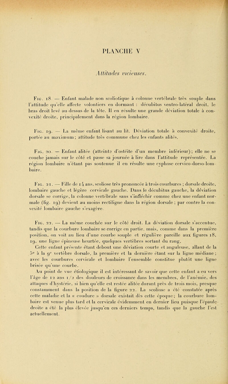 Attitudes vicieuses. Fie. i8 — Enfant malade non scoliotique à colonne vertébrale très souple dans l'attitude qu'elle affecte volontiers en dormant : décubitus ventro-latéral droit, le bras droit levé au-dessus de la tète. Il en résulte une grande déviation totale à con- vexité droite, principalement dans la région lombaire. FiG. 19. — La même enfant lisant au lit. Déviation totale à convexité droite, portée au maximum; attitude très commune chez les enfants alités. FiG. 20. — Enfant alitée (atteifita d'ostéite d'un membre inférieur); elle ne se couche jamais sur le côté et passe sa journée à lire dans l'attitude représentée. La région lombaire n'étant pas soutenue il en résulte une cyphose cervico-dorso-lom- baire. FiG. 21. — Fille de 14 ans, scoliose très prononcée à trois courbures ; dorsale droite, lombaire gauche et légère cervicale gauche. Dans le décubitus gauche, la déviation dorsale se corrige, la colonne vertébrale sans s'infléchir comme chez une enfant nor- male (fig. 19) devient au moins rectiligne dans la région dorsale ; par contre la con- vexité lombaire gauche s'exagère. FiG. 22. — La même couchée sur le côté droit. La déviation dorsale s'accentue, tandis que la courbure lombaire se corrige en partie, mais, comme dans la première position, on voit au lieu d'une courbe souple et régulière pareille aux figures 18, ig, une ligne épineuse heurtée, quelques vertèbres sortant du rang. Cette enfant présente étant debout une déviation courte et anguleuse, allant de la 5<= à la Q'^ vertèbre dorsale, la première et la dernière étant sur la ligne médiane ; avec les courbures cervicale et lombaire l'ensemble constitue plutôt une ligne brisée qu'une courbe. Au point de vue étiologique il est intéressant de savoir c^ue celte enfant a eu vers l'âge de 12 ans 1/2 des douleurs de croissance dans les membres, de l'anémie, des attaques d'hystérie, si bien qu'elle est restée alitée durant près de trois mois, presque conslamment dans la position de la figure 22. La scoliose a été constatée après cette maladie et la « coudure » dorsale existait dès cette époque; la courbure lom- baire est venue plus tard et la cervicale évidemment en dernier lieu puisque l'épaule droite a été la plus élevée jusqu'en ces derniers temps, tandis cjue la gauche l'est actuellement.