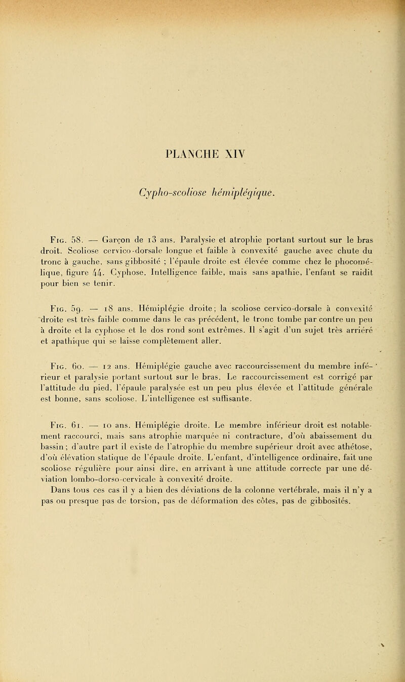 Cypho-scoliose hemiplégique. FiG. 58. — Garçon de i3 ans. Paralysie et atrophie portant surtout sur le bras droit. Scoliose cervico-dorsale longue et faible à convexité gauche avec chute du tronc à gauche, sans gibbosilé ; l'épaule droite est élevée comme chez le phocomé- lique, figure 44- Cyphose. Intelligence faible, mais sans apalhie, l'enfant se raidit pour bien se tenir. FiG. Sg. — i8 ans. Hémiplégie droite; la scoliose cervico-dorsale à convexité droite est très faible comme dans le cas précédent, le tronc tombe par contre un peu à droite et la cyphose et le dos rond sont extrêmes. Il s'agit d'un sujet très arriéré et apathique qui se laisse complètement aller. FiG. 60. — 12 ans. Hémiplégie gauche avec raccourcissement du membre infé- rieur et paralysie portant surtout sur le bras. Le raccourcissement est corrigé par l'attitude du pied, l'épaule paralysée est un peu plus élevée et l'attitude générale est bonne, sans scoliose. L'intelligenee est suffisante. FiG. 61. ■—• 10 ans. Hémiplégie droite. Le membre inférieur droit est notable- ment raccourci, mais sans atrophie marquée ni contracture, d'où abaissement du bassin; d'autre part il existe de l'atrophie du membre supérieur droit avec athétose, d'où élévation statique de l'épaule droite. L'enfant, d'intelligence ordinaire, fait une scoliose régulière pour ainsi dire, en arrivant à une attitude correcte par une dé- viation lombo-dor.so-cervicale à convexité droite. Dans tous ces cas il y a bien des déviations de la colonne vertébrale, mais il n'y a pas ou presque pas de torsion, pas de déformation des côtes, pas de gibbosités.