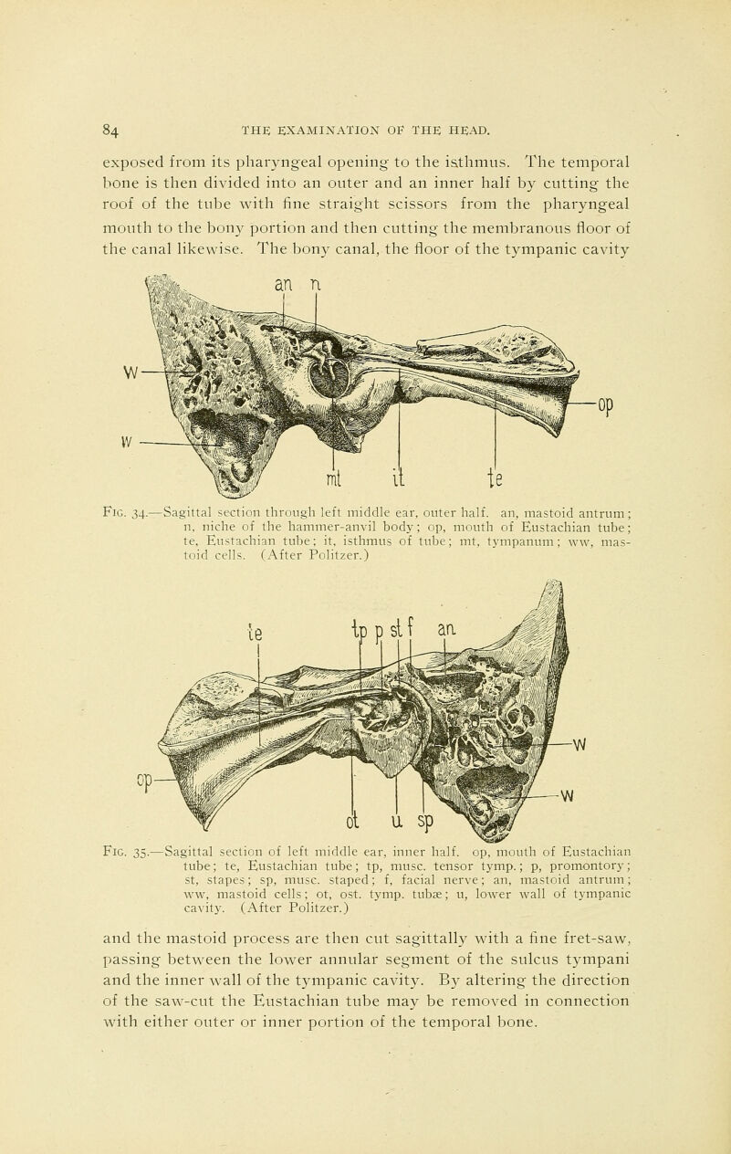 exposed from its pharyngeal opening to the isthmus. The temporal bone is then divided into an outer and an inner half by cutting the roof of the tube with fine straight scissors from the pharyngeal mouth to the bony portion and then cutting the membranous floor of the canal likewise. The bony canal, the floor of the tympanic cavity an n Fig. 34.—Sagittal section through left middle ear, outer half, an, mastoid antrum; n, niche of the hammer-anvil body; op, mouth of Eustachian tube; te. Eustachian tube; it, isthmus of tube; mt, tympanum; ww, mas- toid cells. (After Politzer.) Fig. 35.—Sagittal section of left middle ear, inner half, op, mouth of Eustachian tube; te, Eustachian tube; tp, muse, tensor tymp.; p, promontory; st, stapes; sp, muse, staped; f, facial nerve; an, mastoid antrum; ww, mastoid cells; ot, ost. tymp. tubae; u, lower wall of tympanic cavity. (After Politzer.) and the mastoid process are then cut sagittally with a fine fret-saw, passing between the lower annular segment of the sulcus tympani and the inner wall of the tympanic cavity. By altering the direction of the saw-cut the Eustachian tube may be removed in connection with either outer or inner portion of the temporal bone.