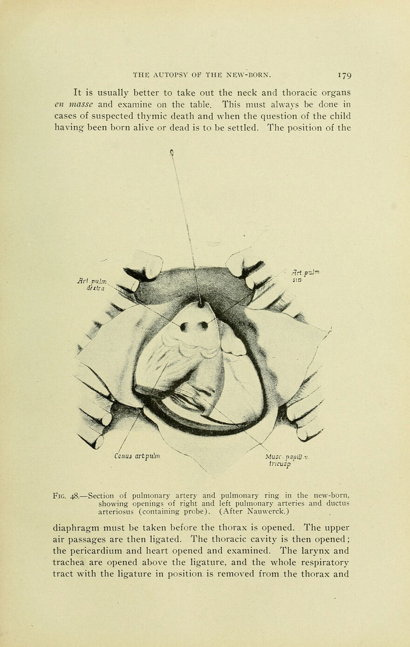 It is usually better to take out the neck and thoracic organs en masse and examine on the table. This must always be done in cases of suspected thymic death and when the question of the child having been born alive or dead is to be settled. The position of the d/xtra tfrt.pnlm Cenus artpulm Mu.sc papttv. tricusp Fig. 48.—Section of pulmonary artery and pulmonary ring in the new-born, showing openings of right and left pulmonary arteries and ductus arteriosus (containing probe). (After Nauwerck.) diaphragm must be taken before the thorax is opened. The upper air passages are then ligated. The thoracic cavity is then opened; the pericardium and heart opened and examined. The larynx and trachea are opened above the ligature, and the whole respiratory tract with the ligature in position is removed from the thorax and