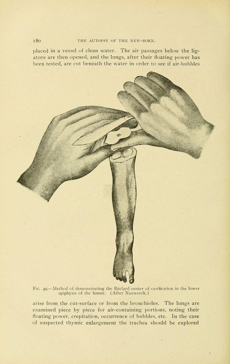 placed in a vessel of clean water. The air passages below the lig- ature are then opened, and the lungs, after their floating power has been tested, are cut beneath the water in order to see if air-bubbles fc Fig. 49.—Method of demonstrating the Beclard center of ossification in the lower epiphysis of the femur. (After Nanwerck.) arise from the cut-surface or from the bronchioles. The lungs are examined piece by piece for air-containing portions, noting their floating power, crepitation, occurrence of bubbles, etc. In the case of suspected thymic enlargement the trachea should be explored