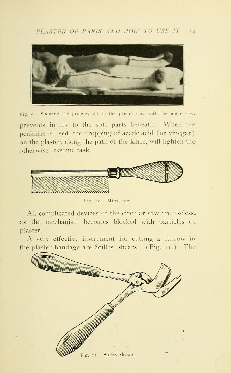 .last ist witn the mitre saw, Fig. 9. Showing the grooves cut m prevents injur)' to the soft parts beneath. When the penknife is used, the dropping of acetic acid (or vinegar) on the plaster, along the path of the knife, will lighten the otherwise irksome task. Fig. 10. Mitre saw. All complicated devices of the circular saw are useless, as the mechanism becomes blocked with particles of plaster. A very effective instrument for cutting a furrow in the plaster bandage are Stilles' shears. (Fig. 11.) The Fia:. ii. Stilles shears.