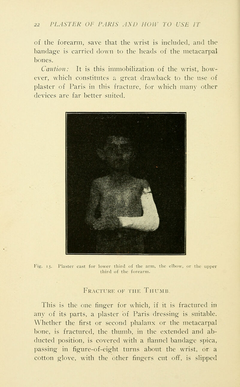 of the forearm, save that the wrist is included, and the bandage is carried down to the heads of the metacarpal bones. Caution: It is this immobilization of the wrist, how- ever, which constitutes a great drawback to the use of plaster of Paris in this fracture, for which man}- other deAuces are far better suited. Plaster cast for lower third of the arm, the elbow third of the forearm. the upper Fracture of the Thumb. This is the one finger for which, if it is fractured in any of its parts, a plaster of Paris dressing is suitable. Whether the first or second phalanx or the metacarpal bone, is fractured, the thumb, in the extended and ab- is covered with a flannel bandage spica, ducted position ■passin ing in figure-of-eight turns about the wrist or a cotton glove, with the other lingers cut off, is slipped