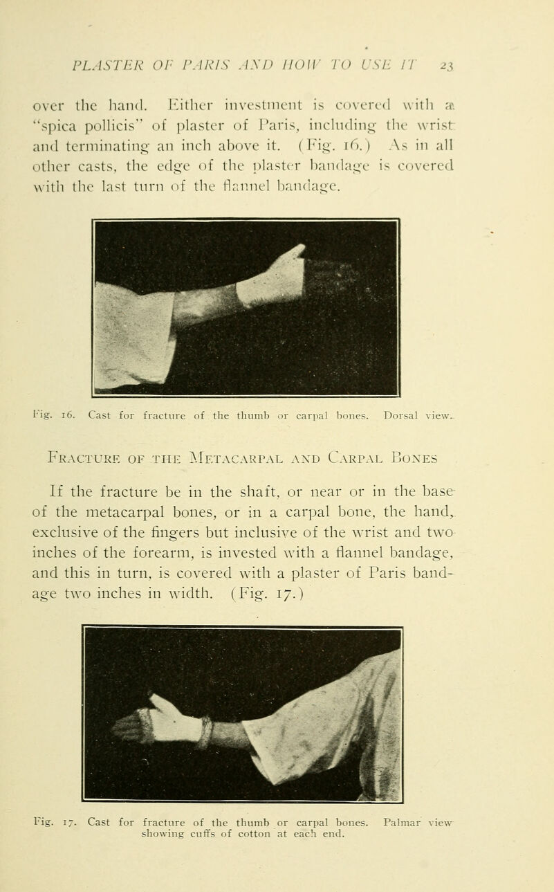 over the hand. Either investment is covered with a spica pollicis of plaster of Paris, including the wrist and terminating an inch above it. ( Fig. [6.) As in all other casts, the edge of the plaster bandage is covered with the last turn of the flannel bandage. Fig. 16. Cast for fracture of the thumb or carpal bones. Dorsal view. Fracture of the Metacarpal axd Carpal Boxes If the fracture be in the shaft, or near or in the base of the metacarpal bones, or in a carpal bone, the hand,, exclusive of the fingers but inclusive of the wrist and two inches of the forearm, is invested with a flannel bandage, and this in turn, is covered with a plaster of Paris band- age two inches in width. (Fig. 17.) Fig. 17. Cast for fracture of the thumb or carpal bones. Palmar view showing cuffs of cotton at each end.