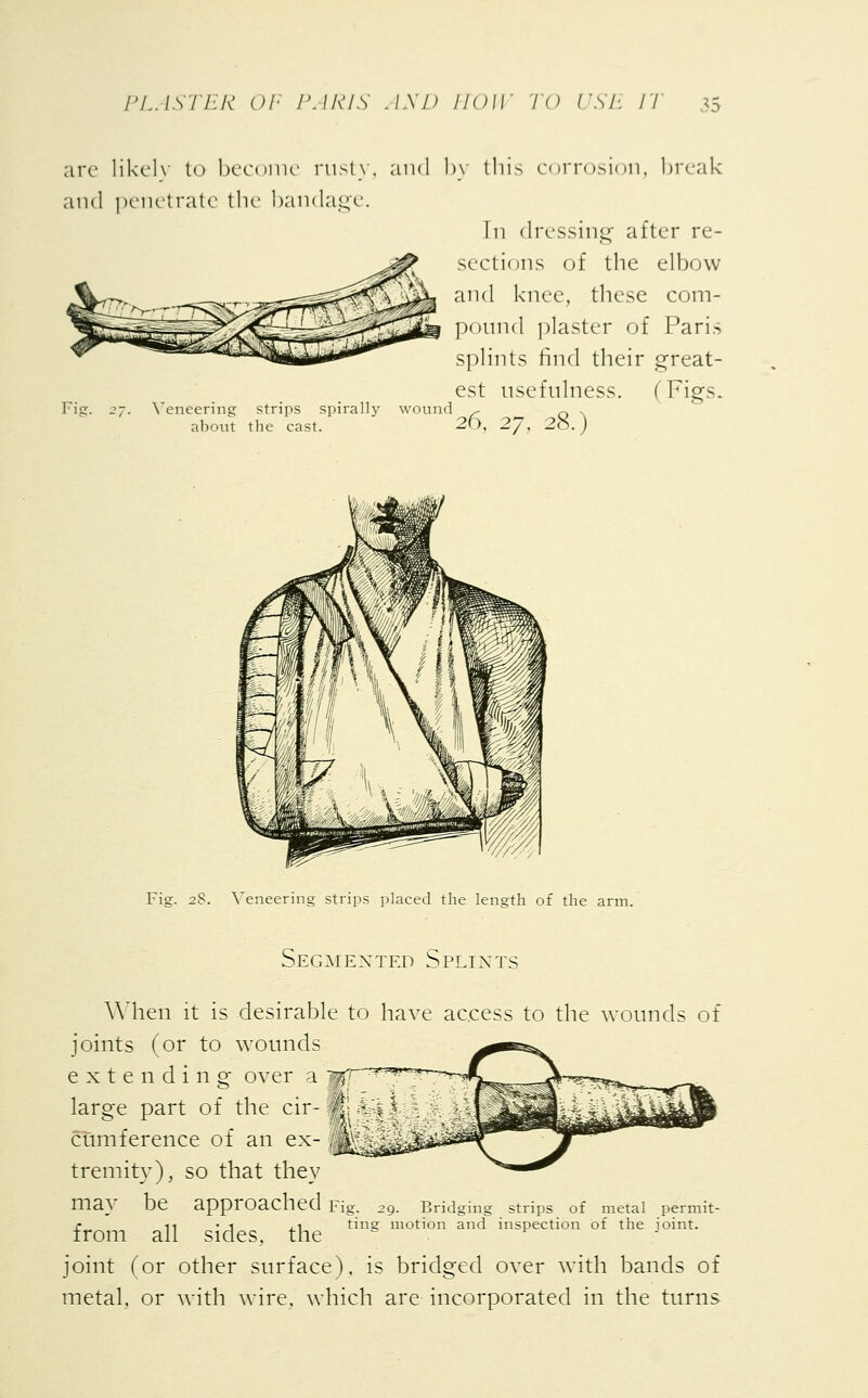 are likely to become rusty, and by this corrosion, break and penetrate the bandage. In dressing after re- sections of the elbow and knee, these com- pound plaster of Paris splints rind their great- est usefulness. (Figs. Fig. 27. Veneering strips spirally wound ^ Q . about the cast. 20, 2J, 2o.) Fig. 28. Veneering strips placed the length of th< Segmented Splints AYhen it is desirable to have access to the wounds of joints (or to wounds extending over a large part of the cir- M j| cUmference of an ex- | tremity), so that they maV be approached Fig. 29. Bridging strips of metal permit- from all sides, the ting mot,on and msPectlon of the J°int- joint (or other surface), is bridged over with bands of metal, or with wire, which are incorporated in the turns