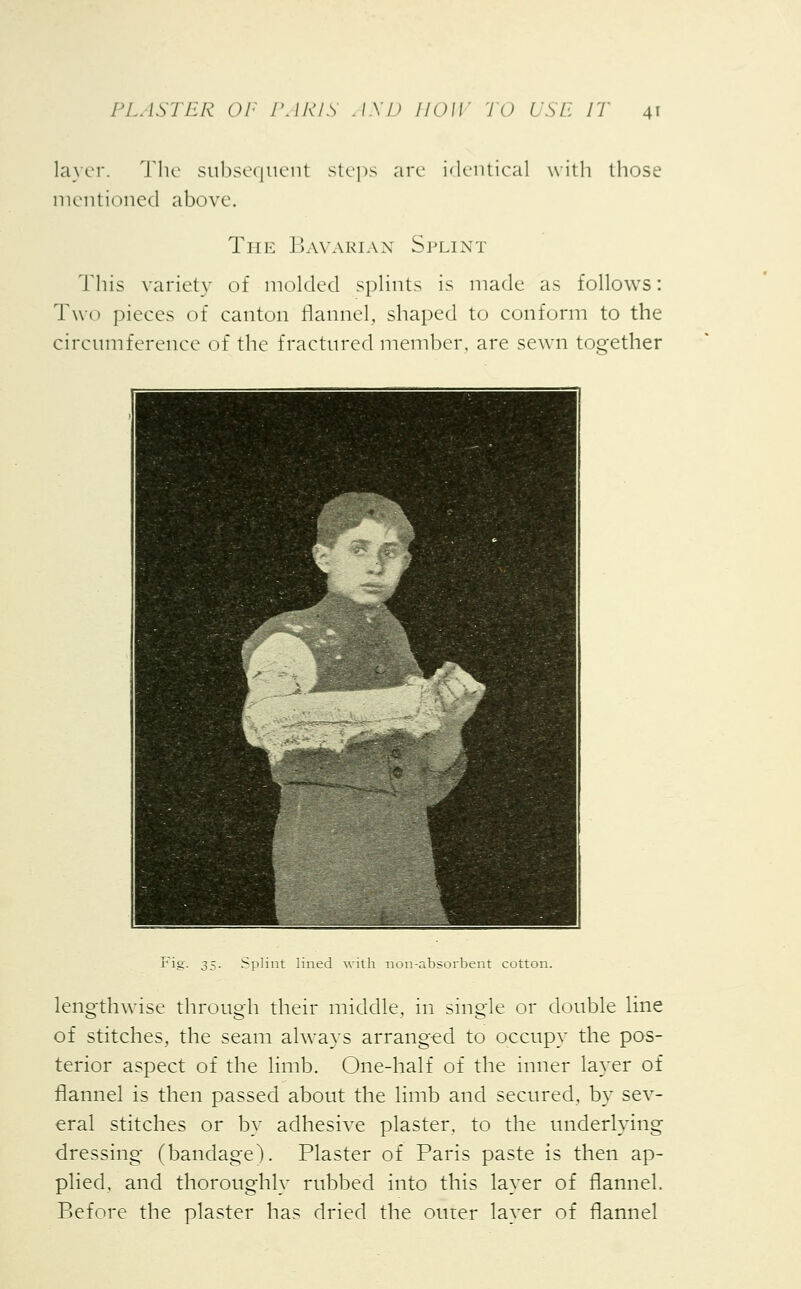 layer. The subsequent steps arc identical with those mentioned above. The Bavarian Splint This variety of molded splints is made as follows: Two pieces of canton flannel, shaped to conform to the circumference of the fractured member, are sewn together Fig. 35. Splint lined with non-absorbent cotton. lengthwise through their middle, in single or double line of stitches, the seam always arranged to occupy the pos- terior aspect of the limb. One-half of the inner layer of flannel is then passed about the limb and secured, by sev- eral stitches or by adhesive plaster, to the underlying dressing (bandage). Plaster of Paris paste is then ap- plied, and thoroughly rubbed into this layer of flannel. Before the plaster has dried the outer layer of flannel