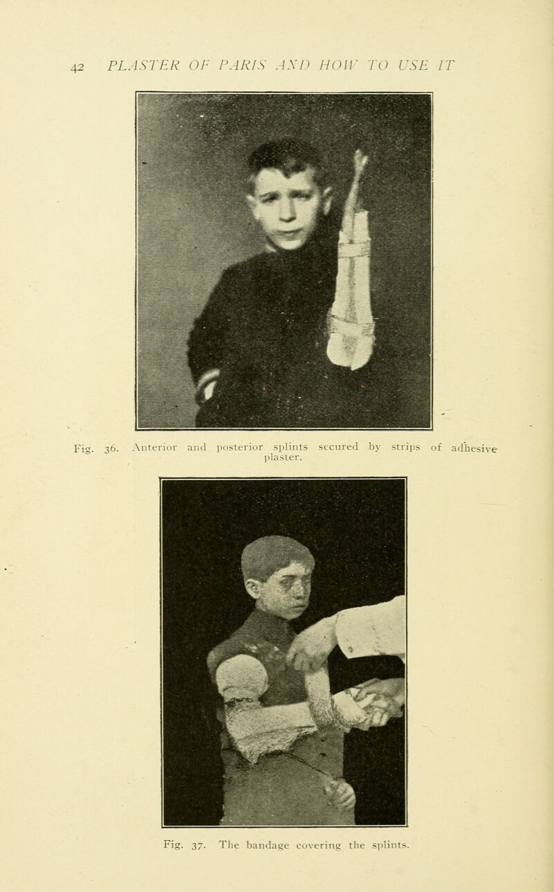 Fig. 36. Ant enor ai ;terior splints secured by strips of adhesive plaster. 1 1 Bmtefo.^ '^KP^^ mt^r ' . fcr'^* ^H KS?wfc. ' itS0**~-&?- °* B 1 Fig. 37. The bandage covering the splints