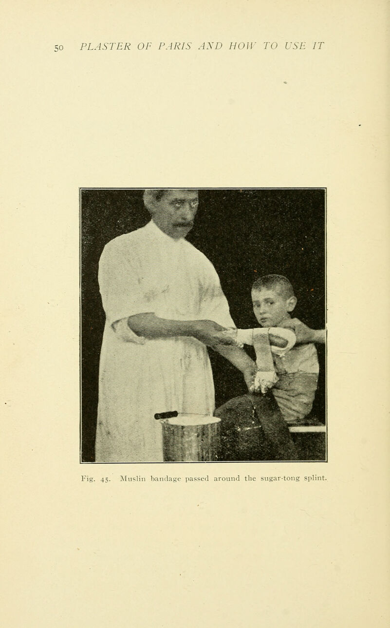 Fig. 45. Muslin bandage passed around the sugar-tong splint.