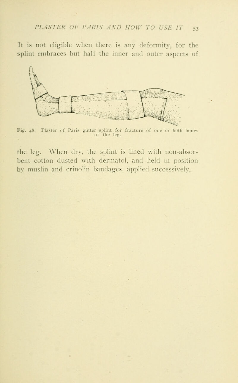 It is not eligible when there is any deformity, for the splint embraces but half the inner and outer aspects of Fig. 48. Plaster of Paris gutter splint for fracture of one or both bones of the leg. the leg. When dry, the splint is lined with non-absor- bent cotton dusted with dermatol. and held in position by muslin and crinolin bandages, applied successively.