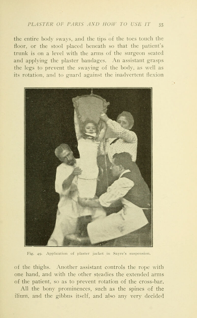 the entire body -ways, and the tips of the toes touch the floor, or the stool placed beneath so that the patient's trunk is on a level with the arms of the surgeon seated and applying the plaster bandages. An assistant grasps the legs to prevent the swaying of the body, as well as its rotation, and to guard against the inadvertent flexion Fig. 49. Application of plaster jacket in Sayre's suspension. of the thighs. Another assistant controls the rope with one hand, and with the other steadies the extended arms of the patient so as to prevent rotation of the cross-bar. All the bony prominences, such as the spines of the ilium, and the gibbus itself, and also any very decided