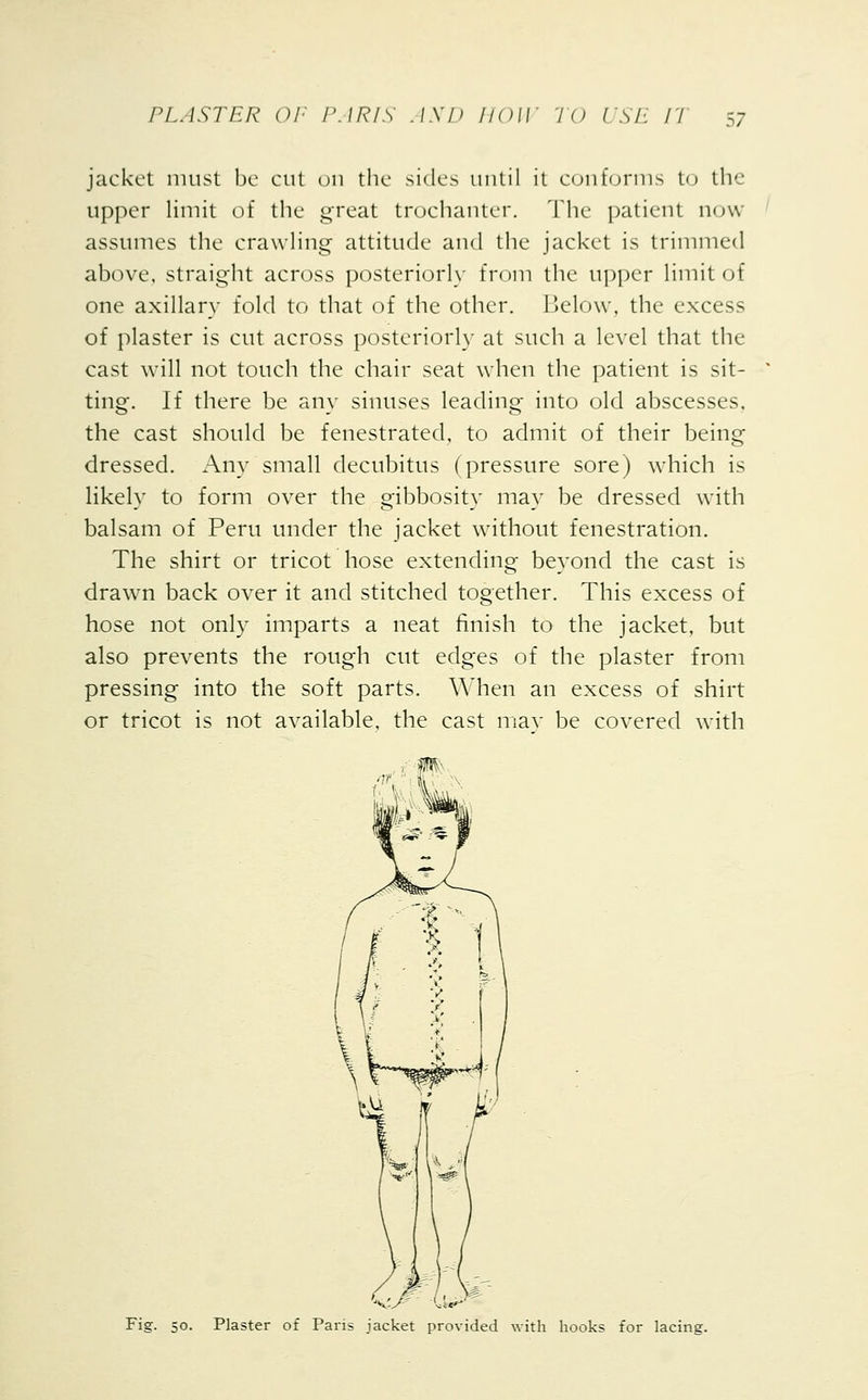 jacket must be cut on the sides until it conforms to the upper limit of the great trochanter. The patient now assumes the crawling attitude and the jacket is trimmed above, straight across posteriorly from the upper limit of one axillary fold to that of the other. Below, the excess of plaster is cut across posteriorly at such a level that the cast will not touch the chair seat when the patient is sit- ting. If there be any sinuses leading into old abscesses, the cast should be fenestrated, to admit of their being dressed. Any small decubitus (pressure sore) which is likely to form over the gibbosity may be dressed with balsam of Peru under the jacket without fenestration. The shirt or tricot hose extending beyond the cast is drawn back over it and stitched together. This excess of hose not only imparts a neat finish to the jacket, but also prevents the rough cut edges of the plaster from pressing into the soft parts. When an excess of shirt or tricot is not available, the cast may be covered with Fig. 50. Plaster of Paris jacket provided with hooks for lacing.