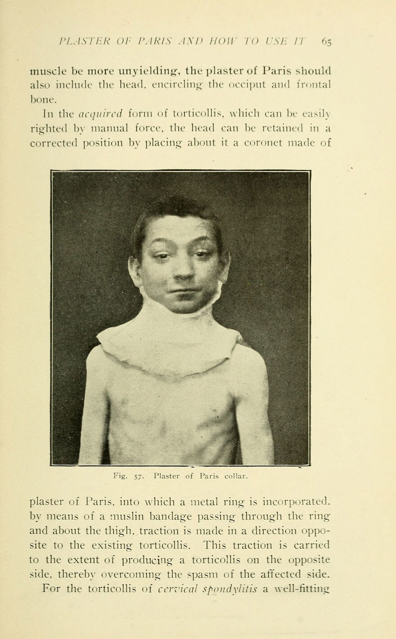 muscle be more unyielding, the plaster of Paris should also include the head, encircling the occiput and frontal Ix >ne. In the acquired form of torticollis, which can be easil) righted by manual force, the head can be retained in a corrected position by placing about it a coronet made of plaster of Paris, into which a metal ring is incorporated. by means of a muslin bandage passing through the ring' and about the thigh, traction is made in a direction oppo- site to the existing torticollis. This traction is carried to the extent of producing a torticollis on the opposite side, thereby overcoming the spasm of the affected side. For the torticollis of cervical spondylitis a well-fitting