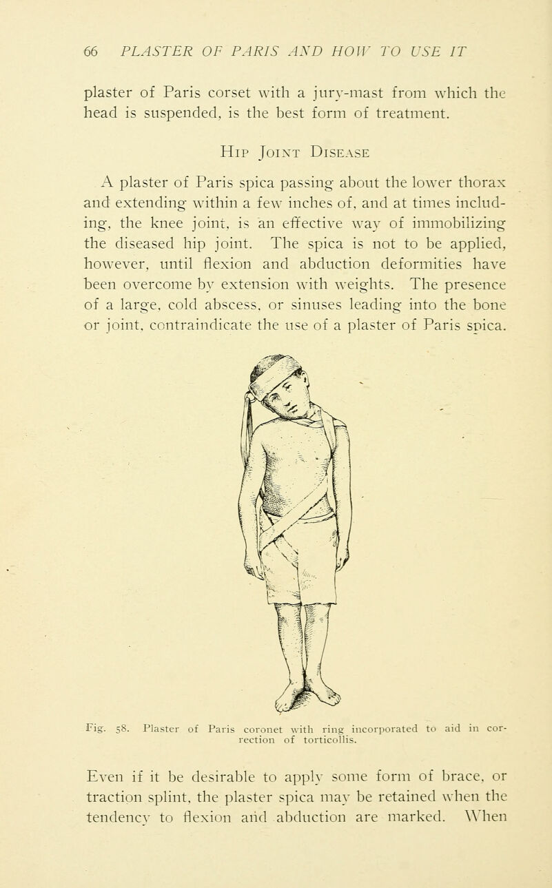 plaster of Paris corset with a jury-mast from which the head is suspended, is the best form of treatment. Hip Joint Disease A plaster of Paris spica passing about the lower thorax and extending within a few inches of, and at times includ- ing, the knee joint, is an effective way of immobilizing the diseased hip joint. The spica is not to be applied, however, until flexion and abduction deformities have been overcome by extension with weights. The presence of a large, cold abscess, or sinuses leading into the bone or joint, contraindicate the use of a plaster of Paris spica. ,^^% Fig. 58. Plaster of Paris coronet with ring incorporated to aid in cor- rection of torticollis. Even if it be desirable to apply some form of brace, or traction splint, the plaster spica may be retained when the tendencv to flexion and abduction are marked. When