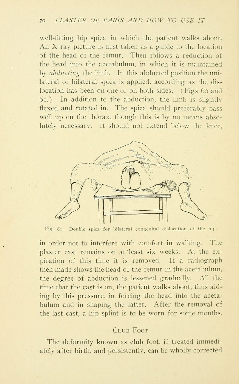 well-fitting hip spica in which the patient walks about. An X-ray picture is first taken as a guide to the location of the head of the femur. Then follows a reduction of the head into the acetabulum, in which it is maintained by abducting the limb. In this abducted position the uni- lateral or bilateral spica is applied, according as the dis- location has been on one or on both sides. (Figs 60 and 61.) In addition to the abduction, the limb is slightly flexed and rotated in. The spica should preferably pass well up on the thorax, though this is by no means abso- lutely necessary. It should not extend below the knee, Fig. 61. Double spica for bilateral congenital dislocation of the hip. in order not to interfere with comfort in walking. The plaster cast remains on at least six weeks. At the ex- piration of this time it is removed. If a radiograph then made shows the head of the femur in the acetabulum, the degree of abduction is lessened gradually. All the time that the cast is on, the patient walks about, thus aid- ing by this pressure, in forcing the head into the aceta- bulum and in shaping the latter. After the removal of the last cast, a hip splint is to be worn for some months. Club Foot The deformity known as club foot, if treated immedi- ately after birth, and persistently, can be wholly corrected