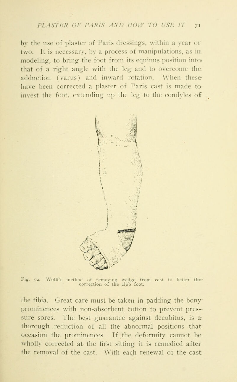 by the use of plaster of Paris dressings, within a war or two. It is necessary, by a process of manipulations, as in modeling, to bring the foot from its equinus position into< that of a right angle with the leg and to overcome the adduction (varus) and inward rotation. When these have been corrected a plaster of Paris cast is made to invest the foot, extending up the leg to the condyles of Fig. 62. Wolff's method of removing wedge from cast to better the- correction of the club foot. the tibia. Great care must be taken in padding the bony prominences with non-absorbent cotton to prevent pres- sure sores. The best guarantee against decubitus, is a thorough reduction of all the abnormal positions that occasion the prominences. If the deformity cannot be- wholly corrected at the first sitting it is remedied after the removal of the cast. With each renewal of the cast