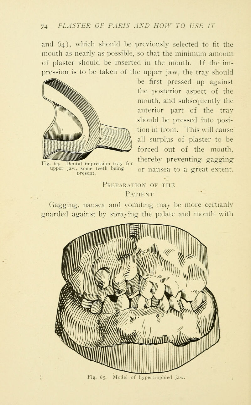 and 64), which should be previously selected to tit the mouth as nearly as possible, so that the minimum amount of plaster should be inserted in the mouth. If the im- pression is to be taken of the upper jaw, the tray should be first pressed up against the posterior aspect of the mouth, and subsequently the anterior part of the tray should be pressed into posi- tion in front. This will cause all surplus of plaster to be forced out of the mouth, thereby preventing ^ao'Sfins: rig. 64. Dental impression tray for upper jaw, some teeth being or nailSea tO a S^eat extent, present. ° Preparation of the Patient Gagging, nausea and vomiting may be more certianly guarded against by spraying the palate and mouth with Fig. 65. Model of hypertrophied ja