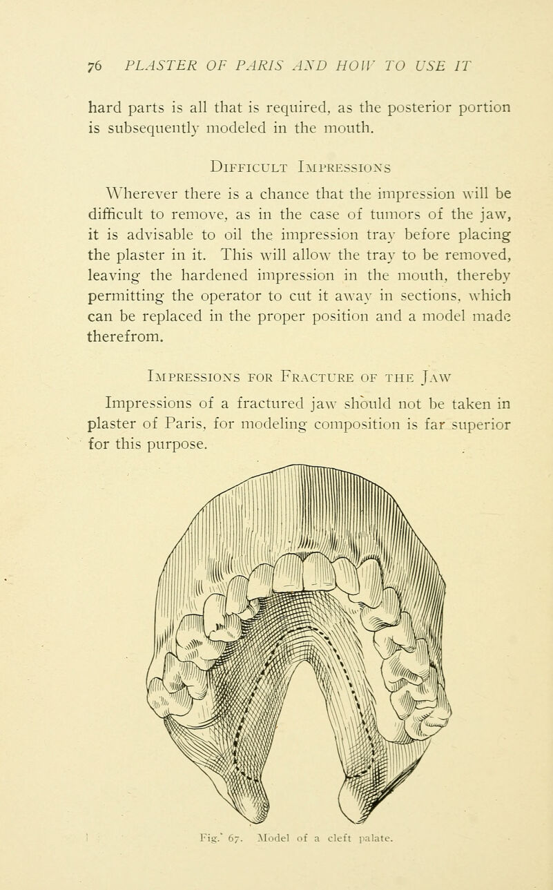 hard parts is all that is required, as the posterior portion is subsequently modeled in the mouth. Difficult Impressions Wherever there is a chance that the impression will be difficult to remove, as in the case of tumors of the jaw, it is advisable to oil the impression tray before placing the plaster in it. This will allow the tray to be removed, leaving the hardened impression in the mouth, thereby permitting the operator to cut it away in sections, which can be replaced in the proper position and a model made therefrom. Impressions for Fracture of the Jaw Impressions of a fractured jaw should not be taken in plaster of Paris, for modeling composition is far superior for this purpose. Fig. 67. Model of a cleft palate.