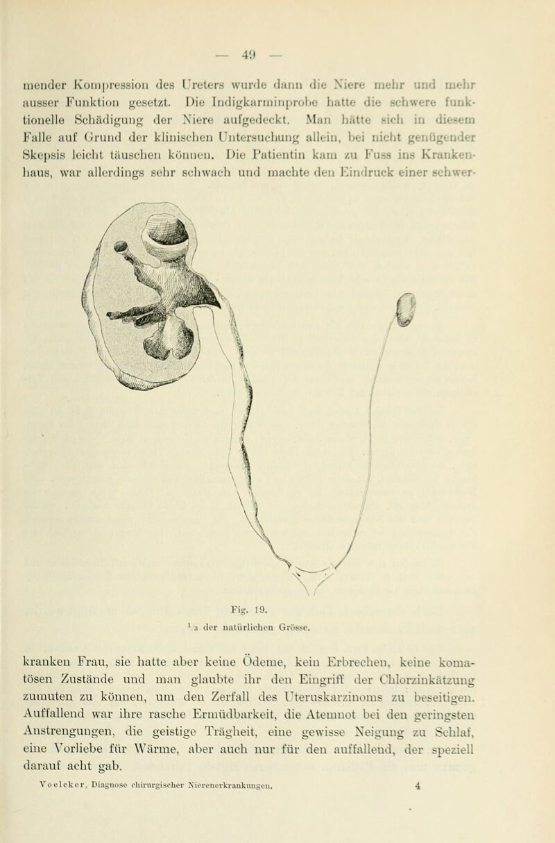 immler Kompression des I'reters wurde dann die <hr ausser Funktion gesetzt. Die Indigkarminprobe hatte nk- tionelle Schädigung der Niere aufgedeckt. Man hätte sich in Falle auf Grund der klinischen Untersuchung allein, bei Dicht Skepsis leichl täuschen können. Die Patientin kam zu F\u haus, war allerdings sehr schwach und machte den Bindruck einer - Fig. 19. 1 ;i der natürlichen Grösse, kranken Frau, sie hatte aber keine Ödeme, kein Erbrechen, keine koma- tösen Zustände und man glaubte ihr den Eingriff der Chlorzinkätzung zumuten zu können, um den Zerfall des (Jteruskarzinoms zu beseitigen. Auffallend war ihre rasche Ermüdbarkeit, die Atemnot bei den geringsten Anstrengungen, die geistige Trägheit, eine gewisse Neigung zu Schlaf, eine Vorliebe für Wärme, aber auch nur für den auffallend, der speziell darauf acht gab. Voeleker, Diagnose chirurgischer Nierenerkrankungeii,