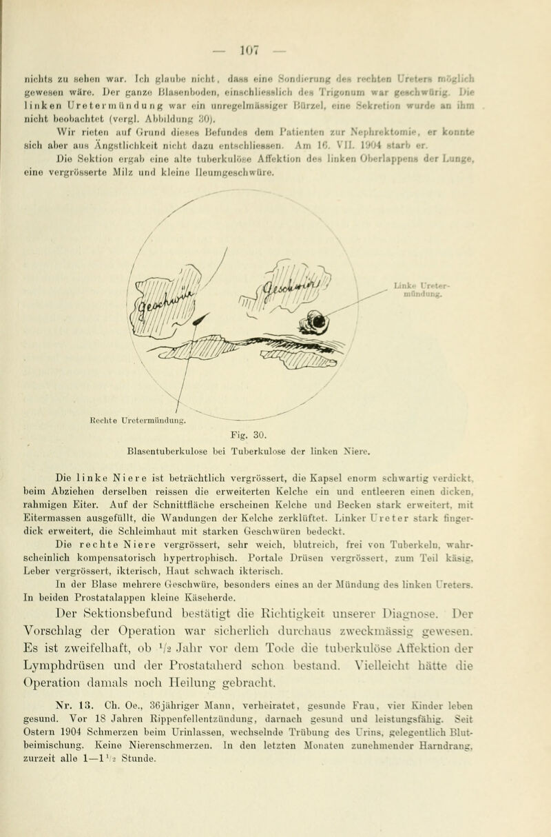 nichts zu sollen war. Icli [_'l;nibe ni< hl , da-.-. BÜU BondiefUDg <!<•- r«-' li gewesen wäre. Bor trau/.'- Bl&MIlbodeil, ein -i hin- ,-ie ,, >j. linken U ro te r in ii n d u n ^ wai i-in imMgelmaeUgei l:../-. BtlOfl wurde an ihm niclit beobachtet (vergl. Abbildung 80)i Wir rieten auf Grund die et Befandet den Patienten eut Nephrektomie, ei b sicli aber uns Ängstlichkeit nicht dazu enteohliesaen Am 16. ^DL Die Sektion ergab eine alte tuberkulo* e Affektion de linket l eine vergrösserte Milz und kl<-ine Ileumgeschwttre. mfii, Kocht e Uretermündung. Fig. 30. Blasentuberkulose l>ei Tuberkulose der linken Niere. Die linke Niere ist beträchtlich vergrüssert, die Kapsel enorm schwartig verdickt, beim Abziehen derselben reissen die erweiterten Kelche ein und entleeren einen dicken, rahmigen Eiter. Auf der Schnittfläche erscheinen Kelche und Becken stark erweitert, mit Eitermassen ausgefüllt, die Wandungen der Kelche zerklüftet. Linker Ureter stark Gl _ dick erweitert, die Schleimhaut mit starken (.-Jeschwüren bedeckt. Die rechte Niere vergrössert, sehr weich, blutreich, frei von Tuberkeln, wahr- scheinlich kompensatorisch hypertrophisch. Portale Drüsen vergrössert, zum Teil k Leber vergrössert, ikterisch. Haut schwach ikterisch. In der Blase mehrere (-iesohwüre, besonders eines an der Mündung des linken Ureters. In beiden Prostatalappen kleine Käseherde. Der Sektionsbefund bestätigt die Richtigkeil unserer Diagnose. Der Vorschlag der Operation war sicherlich durchaus zweckmässig gewesen. Es ist zweifelhaft, ob L/a Jahr vor dem Tode die tuberkulöse Affektion der Lymphdrüsen und der Prostataherd schon bestand. Vielleicht hätte die Operation damals noch Heilung gebracht. Nr. 13. Ch. Oe., 36jähriger Mann, verheiratet, gesunde Frau, viel Kinder leben gesund. Vor IS Jahren Rippenfellentzündung, darnach gesund und leistungsfähig. Seit Ostern 1904 Schmerzen beim Urinlassen, wechselnde Trübung des Urins, gelegentlich Blut- beimischung. Keine Nierenschmerzen. In den letzten Monaten zunehmender Harndrang, zurzeit alle 1—1l a Stunde.