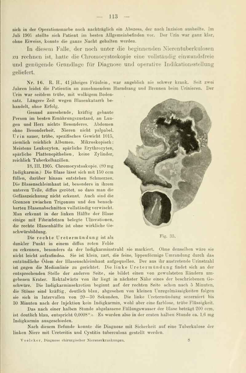 sich in der Operationsnarbe noch oacbträgliob ein ' Im Juli 1905 stollto sich Patient im besten Allgemeinbefinden vor. \>>t Drin k 1 --*r, ohne Eiweiss, konnte die ganze Nacht gebalten werden. In diesem Falle, der noch unter die beginnenden Nlerentuberku] zu rechnen ist. hatte die Chromocystoskopie eine vollständig einwandsl und genügende Grundlage für Diagnose und operative [ndikationssteli geliefert. \r. 1(5. R. H., 41 jähriges Fräulein, war angeblich Die BCbwer krank. Jabren leidet die Patientin an zunehmendem Harndrang und Brennen heim Urinieren. Der Urin war seitdem trübe, mit wolkigem Boden- satz. Längere Zeit wegen Hlasenkafarrli be- ^'^~7'r- r^r~ handelt, ohne Erfolg. ^^ Gesund aussehende, kräftig gebaute Person im hesten Ernährungszustand, an Lun- gen und Herz nichts Besonderes. Abdomen ohne Besonderheit. Nieren nicht palpabel. Urin sauer, trübe, spezifisches Gewicht 1015, ziemlich reichlich Albumen. Mikroskopisch: Meistens Leukozyten, spärliche Erythrozyten, spärliche Plattenepithelien, keine Zylinder, reichlich Tuberkelbazillen. 18. III. 190-5. Chromocystoskopie. (80 mg Indigkarmin.) Die Blase lässt sich mit 150 ccm füllen, darüber hinaus entstehen Schmerzen. Die Blasenschleimhaut ist, besonders in ihrem unteren Teile, diffus gerötet, so dass man die Gefässzeichnung nicht erkennt. Auch sind die Grenzen zwischen Trigonum und den benach- barten Blasenabschnitten vollständig verwischt. Man erkennt in der linken Hälfte der Blase einige mit Fibrinfetzen belegte Ulzerationen, die rechte Blasenhälfte ist ohne wirkliche Ge- schwürsbildung. Die rechte Uretermündung ist als S- 35. dunkler Punkt in einem diffus roten Felde zu erkennen, besonders da der Indigkarminstralil sie markiert. Ohne denselben wäre sie nicht leicht aufzufinden. Sie ist klein, zart, die feine, lippenfönnige Umrandung durch das entzündliche Ödem der Blasenschleimhaut aufgequollen. Der aus ihr austretende Urinstrahl ist gegen die Medianlinie zu gerichtet. Die linke Uretermündung findet sich an der entsprechenden Stelle der anderen Seite, sie bildet einen von gewulsteten Rändern um- gebenen Krater. Rektalwärts von ihr liegt in nächster Nähe eines der beschriebenen Ge- schwüre. Die Indigkarminsekretion beginnt auf der rechten Seite schon nach 5 Minuten, die Stösse sind kräftig, deutlich blau, abgesehen von kleinen In regelmässigkeiten folgen sie sich in Intervallen von 20—30 Sekunden. Die linke l'retermündung se/.erniert bis 30 Minuten nach der Injektion kein Indigkarmin, wohl aber eine farblose, trübe Flüssigkeit. Das nach einer halben Stunde abgelassene Füllungswasser der Blase beträgt 200 com. ist deutlich blau, entspricht 0,00ÜS° o. Es wurden also in der eisten halben Stunde ca. 1.6 mg Indigkarmin ausgeschieden. Nach diesem Befunde konnte die Diagnose mit Sicherheit auf eine Tuberkulose der linken Niere mit Ureteritis und Ovstitis tubereulosa gestellt werden. Voeleker, Diagnose chirurgischer Nierenerkrankungen. 8