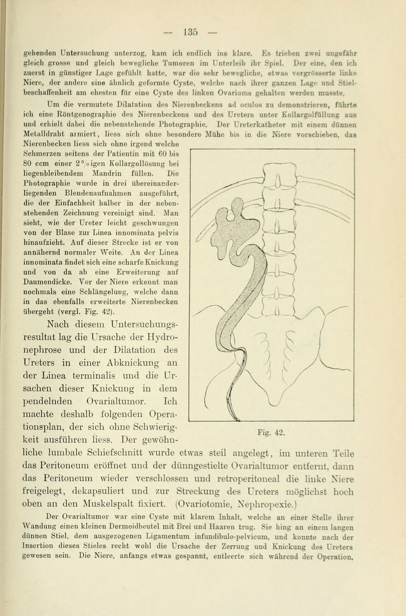 — 136 gehenden Untersuchung unterzog, kam ich endlich in-, 1 lare. Bfl trieben - gleich grosso und gleich bewegliche Tumoren im Unterleib ihr BpieL Dex eine, den ich zuerst in günstiger Lage gefühlt hatte, war die sehr bewegliche, • inke Niere, der andere eine ähnlich geformte Cyste, (reiche nach Quer ganzen Lag- und : beschaffenheit am ehesten für eino Cyste des linken Ovariuma gehalten werden rnusste. Um die vermutete Dilatation des Nierenbeckens ad oculos zu demonstrieren, führt« ich eine Röntgenographio des Nierenbeckens und des Ureters unter Kollargolfüllung aus und erhielt dabei die nebenstehende Photographie. Der Ureterkatheter mit einem dfin Metalldraht armiert, liess sich ohne besondere Mühe bis in die Niere vorschieben, das Nierenbecken liess sich ohne irgend welche Schmerzen seitens der Patientin mit 60 bis 80 cem einer 2° oigen Kollargollösung bei liegenbleibendem Mandrin füllen. Die Photographie wurde in drei übereinander- liegenden Blendenaufnahmen ausgeführt, die der Einfachheit halber in der neben- stehenden Zeichnung vereinigt sind. Man sieht, wie der Ureter leicht geschwungen von der Blase zur Linea innominata pelvis hinaufzieht. Auf dieser Strecke ist er von annähernd normaler Weite. An der Linea innominata findet sich eine scharfe Knickung und von da ab eine Erweiterung auf Daumendicke. Vor der Niere erkennt man nochmals eine Schlängelung, welche dann in das ebenfalls erweiterte Nierenbecken übergeht (vergl. Fig. 42). Nach diesem Untersuchungs- resultat lag die Ursache der Hydro nephrose und der Dilatation des Ureters in einer Abknickung an der Linea terrninalis und die Ur- sachen dieser Knickung in dem pendelnden Ovarialtumor. Ich machte deshalb folgenden Opera- tionsplan, der sich ohne Schwierig- keit ausführen liess. Der gewöhn- liche lumbale Schiefschnitt wurde etwas steil angelegt, im unteren Teile das Peritoneum eröffnet und der dünngestielte Ovarialtumor entfernt, dann das Peritoneum wieder verschlossen und retroperitoneal die linke Niere freigelegt, dekapsuliert und zur Streckung des Ureters möglichst hoch oben an den Muskelspalt fixiert. (Ovariotomie, Nephropexie.) Der Ovarialtumor war eine Cyste mit klarem Inhalt, welche an einer Stelle ihrer Wandung einen kleinen Dermoidbeutel mit Brei und Haaren trug. Sie hing an einem lausen dünnen Stiel, dem ausgezogenen Ligamentum infundibulo-pelvieum. und konnte nach der Insertion dieses Stieles recht wohl die Ursache der Zerrung und Knickung des Ureters gewesen sein. Die Niere, anfangs etwas gespannt, entleerte sich während der Operation.