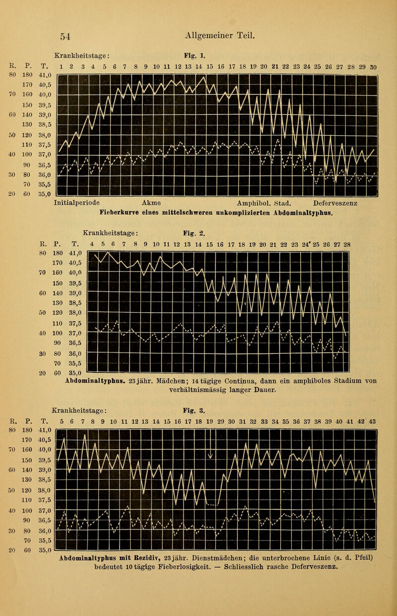 Krankheitstage: R. P. T. 12 3 4 5 6 7 80 180 41,0 170 40,5 70 160 40,0 150 39,5 60 140 39,0 130 38,5 50 120 38,0 110 37,5 40 100 37,0 90 36,5 30 80 36,0 70 35,5 20 60 35,0 Flg. 1. 9 10 11 12 13 14 15 16 17 18 19 20 21 22 23 24 25 26 27 28 29 30 ■■■■■■■inHiii6gBRB|H!gi!BH|anng| laoiinBiiiiüäissMaiinBH _ saaiiinssiiiBBSSHimisiBiiB gm mmi «»»»»■■■■■■■■■■■■■■■liHBaniAlÜLlHi ■■UBwaaaBHMHmBaMaei BBSBiRBB Initialperiode Akme Amphibol. Stad. Deferveszenz Fieberknrre eines mittelschireren nnkomplizierten Abdominaltyphns. Krankheitstage: Fig. 2. R. P. T. 4 5 6 7 8 9 10 11 12 13 14 15 16 17 18 19 20 21 22 23 24'25 26 27 80 180 41,0 170 40,5 70 160 40,0 150 39,5 60 140 39,0 130 38,5 50 120 38,0 110 37,5 40 100 37,0 90 36,5 30 80 36,0 70 35,5 20 60 35,0 jiBaiainiiBEaiHi jBBaBBaaMiMmMi HBaaaaaaaaaaaaaaaaaaaa^t R. P. T. 80 180 41,0 170 40,5 70 160 40,0 150 39,5 60 140 39,0 130 38,5 50 120 38,0 110 37,5 40 100 37,0 90 36,5 80 80 36,0 70 35,5 20 60 35,0 ou,v/ '— Abdominaltyphns. 23jähr. Mädchen; I4tägige Continua, dann ein ampMboles Stadium von verhältnismässig langer Dauer. Krankheitstage: Fig. 3. 5 6 7 8 9 10 11 12 13 14 15 16 17 18 19 29 30 31 32 33 34 35 36 37 38 39 40 41 42 43 ia!?H8aaaaaaaaaaaaaaHaaaaaai a^ioiiBaaaaaaaRnif&affiBaBaaaal aaaaaala!HiaäaBaaBallaaaaaba BBsaaaaaaaiaaaaaaaBaaaaaaaaaaa aauaaaaaaaaaaaaaanaaaaaaaaaa Abdominaltfphns mit BezidiT, 23jähr. Dienstmädchen; die unterbrochene Linie (s. d. Pfeil) bedeutet lOtägige Fieberlosigkeit. — Schliesslich rasche Deferveszenz.