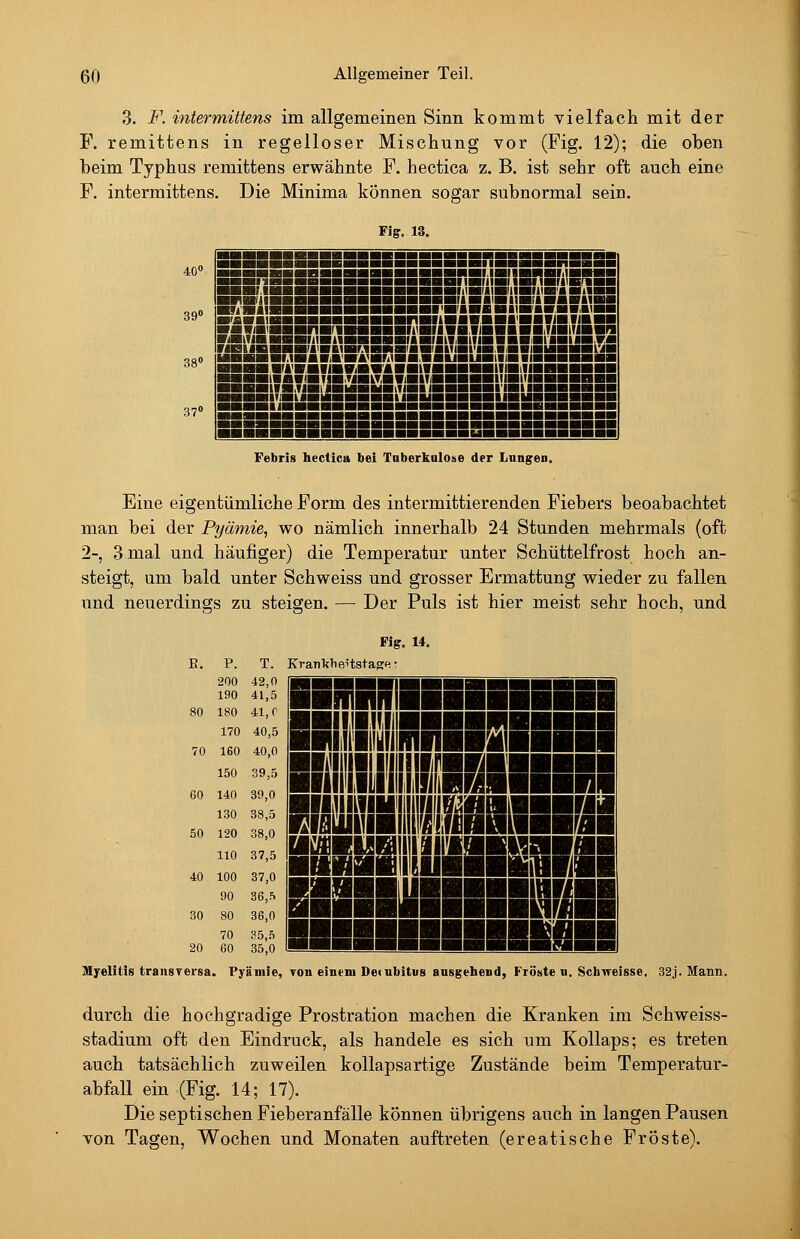 3. F. intermütens im allgemeinen Sinn kommt vielfach mit der F. remittens in regelloser Mischung vor (Fig. 12); die oben beim Typhus remittens erwähnte F. hectica z. B. ist sehr oft auch eine F. intermittens. Die Minima können sogar subnormal sein. Fiff. 13. 40» 39» 38» 37» irt ■!!■■■■■■■■■■ -mium ■BKiiiiBiiBSSi MHHI ■■an ■■■lll ■■■ri ■■'■« ■»■■ IIISH iritia IIBUH ■■■■■■liIHBHH iriBiiHriwnaH ■IIIHI11B«BtlHH ■DBiiHaHiigg ■■(■'■■.■■a«B ■■■■iMailIHBIi ■■■iBi'iaifB'*' liBBHMHHHL'il IWAVMI mViBWABHkiaHBHaif HillBHBHHHB inBrailB.TIHkTBWiBITiaHBgHlligillBgBHBI— IIIHiTIHI ■■MHMBlTiHI !■■■■■! !■! ■■■■■■I ■»■■■■■■■■■■■■■■■■■■■■BHHMHI Febris hectica bei TaberkulOüe der Lnngren. Eine eigentümliche Form des intermittierenden Fiebers beoabachtet man bei der Pyämie, wo nämlich innerhalb 24 Stunden mehrmals (oft 2-, 3 mal und häufiger) die Temperatur unter Schüttelfrost hoch an- steigt, um bald unter Schweiss und grosser Ermattung wieder zu fallen und neuerdinffs zu steigen. — Der Puls ist hier meist sehr hoch, und E. P. T. 200 42,0 190 41,5 80 180 41, r 170 40,5 70 160 40,0 150 39,5 60 140 39,0 130 38,5 50 120 38,0 110 37,5 40 100 37,0 90 36,5 30 80 36,0 70 85,5 20 60 35,0 itis transversa . Fy äniie Fig. 14. KraTiklieitstagH? IIUYII iiiir miiBai Mi iir Ki'iDiiiri fsraitiwsssaiii BiiiiiHiinai fiil von einem Dernbitus ausgehend, Fröste n. Schweisse. 32j. Mann. durch die hochgradige Prostration machen die Kranken im Schweiss- stadium oft den Eindruck, als handele es sich um Kollaps; es treten auch tatsächlich zuweilen kollapsartige Zustände beim Temperatur- abfall ein (Fig. 14; 17). Die septischen Fieberanfälle können übrigens auch in langen Pausen von Tagen, Wochen und Monaten auftreten (ereatische Fröste).