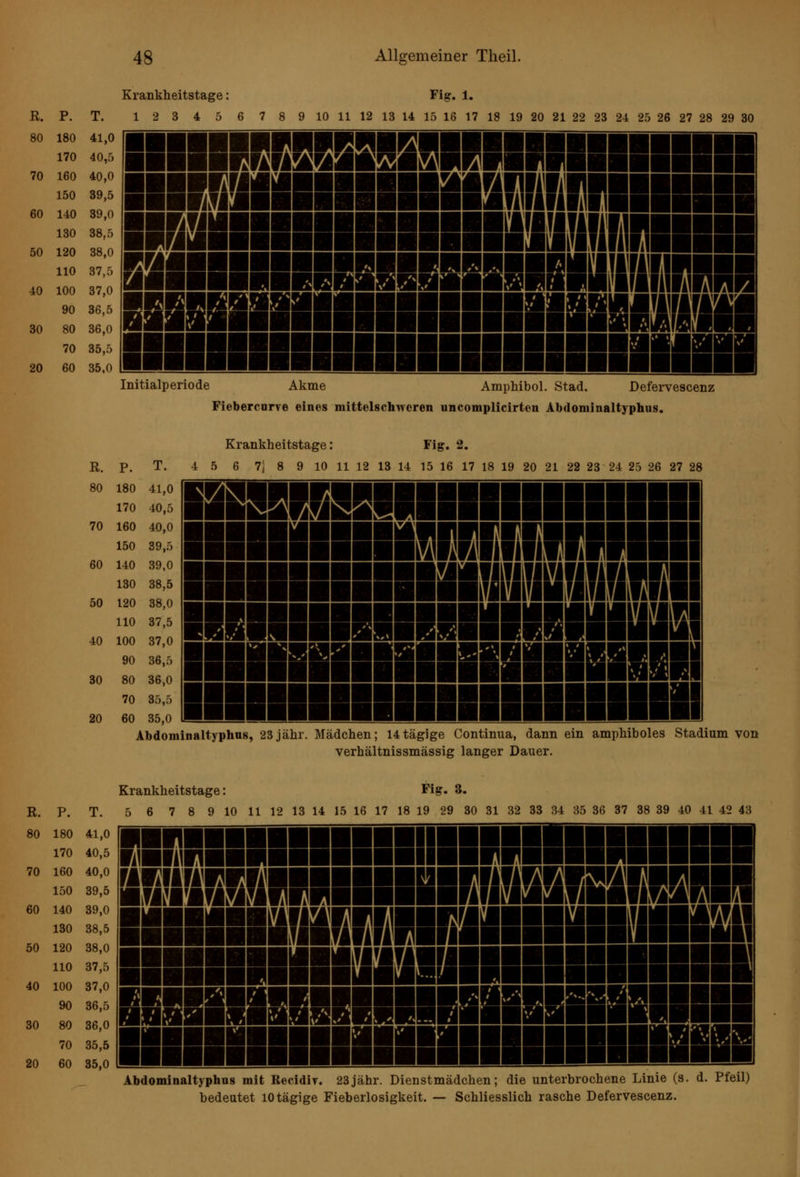 pnniffisessiaiNiiiiimMii miSSSMIlUIIBiHMinilllBai HsaiiiinumniiiHMiHi BÜHUHnSIffiSBfflBiilHIilill Krankheitstage: Fig. 1. R. P. T. 1 2 3 4 5 6 7 8 9 10 11 12 13 14 15 16 17 18 19 20 21 22 23 24 25 26 27 28 29 30 80 180 41,0 170 40,5 70 160 40,0 150 39,5 60 140 39,0 130 38,5 50 120 38,0 110 37,5 40 100 37,0 90 36,5 :° iiiiiiiiiiiiiiiiiiiiiiliiiäiii 10 60 .. . ■■■■■■■■■■■■■■■■■■■■■■■■■■■■■■ Initialperiode Akme Amphibol. Stad. Defervescenz Fiebercorye eines mittelschwcren uncomplicirten Abdominaltyphus. Krankheitstage: Fig. 2. R. p. T. 4 5 6 7j 8 9 10 11 12 13 14 15 16 17 18 19 20 21 22 23 24 25 26 27 28 80 180 41,0 170 40,5 70 160 40,0 150 39,5 60 140 39,0 130 38,5 50 120 38,0 110 37,5 40 100 37,0 90 36,5 30 80 36,0 70 35,5 20 60 35,0 ■■iniiniiii iiiiiiii liftTj SB ■ilBHmilllllHIlii ■»■■■■—■■■IWilllMlBl—— KHUHMHlnniMillllllillBd Abdominaltyphus, 23jähr. Mädchen; 14tägige Continua, dann ein amphiboles Stadium von verhältnissmässig langer Dauer. Krankheitstage: Fig. 3. R. P. T. 5 6 7 8 9 10 11 12 13 14 15 16 17 18 19 29 30 31 32 33 B4 35 36 37 38 39 40 41 42 43 80 180 41,0 170 40,5 70 160 40,0 150 39,5 60 140 39,0 130 38,5 50 120 38,0 110 37,5 40 100 37,0 90 36,5 30 80 36,0 70 35,5 20 60 35,0 ik~Jl«WiWi'K1 « JiBte ■HMiiTBmiiBymimiai ■—■IBMMUUOmM BimiHRniHmiimBgnH immmiMMimiMiaBm Abdominaltyphus mit Recidir. 23jähr. Dienstmädchen; die unterbrochene Linie (s. d. Pfeil) bedeutet lOtägige Fieberlosigkeit. — Schliesslich rasche Defervescenz.