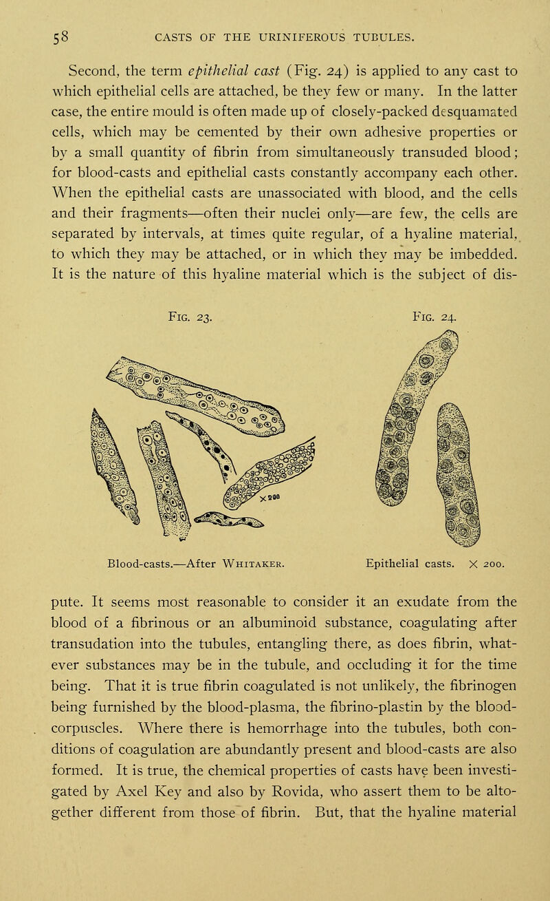 Second, the term epithelial cast (Fig. 24) is applied to any cast to which epithelial cells are attached, be they few or many. In the latter case, the entire mould is often made up of closely-packed desquamated cells, which may be cemented by their own adhesive properties or by a small quantity of fibrin from simultaneously transuded blood; for blood-casts and epithelial casts constantly accompany each other. When the epithelial casts are unassociated with blood, and the cells and their fragments—often their nuclei only—are few, the cells are separated by intervals, at times quite regular, of a hyaline material, to which they may be attached, or in which they may be imbedded. It is the nature of this hyaline material which is the subject of dis- Fig. 23. Fig. 24. Blood-casts.—After Whitaker. Epithelial casts. X 200. pute. It seems most reasonable to consider it an exudate from the blood of a fibrinous or an albuminoid substance, coagulating after transudation into the tubules, entangling there, as does fibrin, what- ever substances may be in the tubule, and occluding it for the time being. That it is true fibrin coagulated is not unlikely, the fibrinogen being furnished by the blood-plasma, the fibrino-plastin by the blood- corpuscles. Where there is hemorrhage into the tubules, both con- ditions of coagulation are abundantly present and blood-casts are also formed. It is true, the chemical properties of casts have been investi- gated by Axel Key and also by Rovida, who assert them to be alto- gether different from those of fibrin. But, that the hyaline material