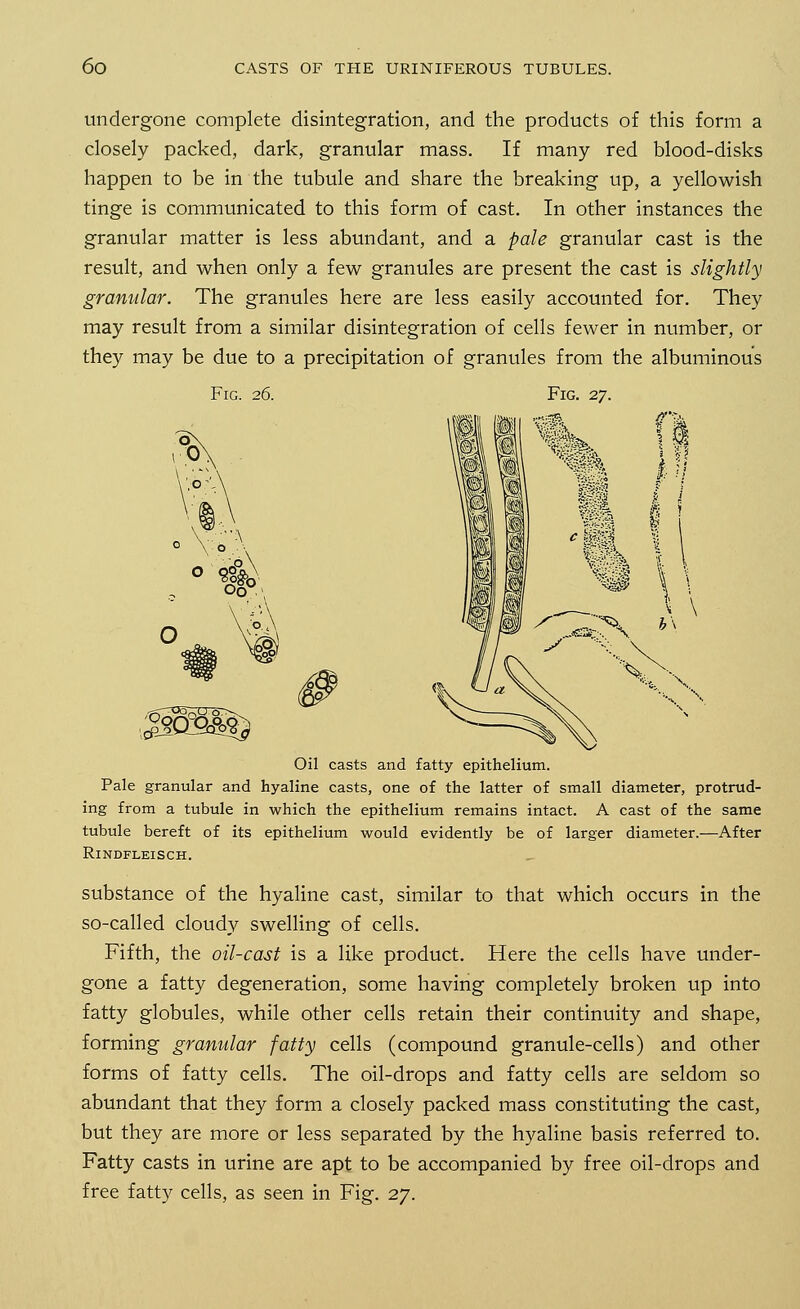 undergone complete disintegration, and the products of this form a closely packed, dark, granular mass. If many red blood-disks happen to be in the tubule and share the breaking up, a yellowish tinge is communicated to this form of cast. In other instances the granular matter is less abundant, and a pale granular cast is the result, and when only a few granules are present the cast is slightly granular. The granules here are less easily accounted for. They may result from a similar disintegration of cells fewer in number, or they may be due to a precipitation of granules from the albuminous Fig. 26. Fig. 27. Oil casts and fatty epithelium. Pale granular and hyaline casts, one of the latter of small diameter, protrud- ing from a tubule in which the epithelium remains intact. A cast of the same tubule bereft of its epithelium would evidently be of larger diameter.—After RlNDFLEISCH. substance of the hyaline cast, similar to that which occurs in the so-called cloudy swelling of cells. Fifth, the oil-cast is a like product. Here the cells have under- gone a fatty degeneration, some having completely broken up into fatty globules, while other cells retain their continuity and shape, forming granular fatty cells (compound granule-cells) and other forms of fatty cells. The oil-drops and fatty cells are seldom so abundant that they form a closely packed mass constituting the cast, but they are more or less separated by the hyaline basis referred to. Fatty casts in urine are apt to be accompanied by free oil-drops and free fatty cells, as seen in Fig. 27.