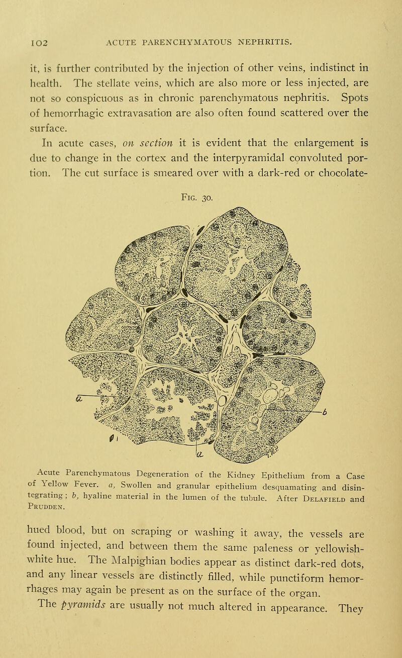 it, is further contributed by the injection of other veins, indistinct in health. The stellate veins, which are also more or less injected, are not so conspicuous as in chronic parenchymatous nephritis. Spots of hemorrhagic extravasation are also often found scattered over the surface. In acute cases, on section it is evident that the enlargement is due to change in the cortex and the interpyramidal convoluted por- tion. The cut surface is smeared over with a dark-red or chocolate- Fig. 30. Acute Parenchymatous Degeneration of the Kidney Epithelium from a Case of Yellow Fever, a, Swollen and granular epithelium desquamating and disin- tegrating; b, hyaline material in the lumen of the tubule. After Delafield and Prudden. hued blood, but on scraping or washing it away, the vessels are found injected, and between them the same paleness or yellowish- white hue. The Malpighian bodies appear as distinct dark-red dots, and any linear vessels are distinctly filled, while punctiform hemor- rhages may again be present as on the surface of the organ. The pyramids are usually not much altered in appearance. They