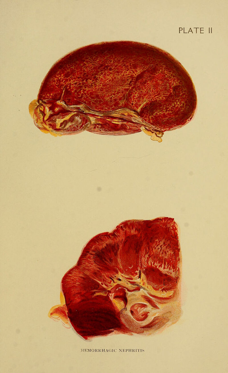 HEMORRHAGIC NEPHRITIS