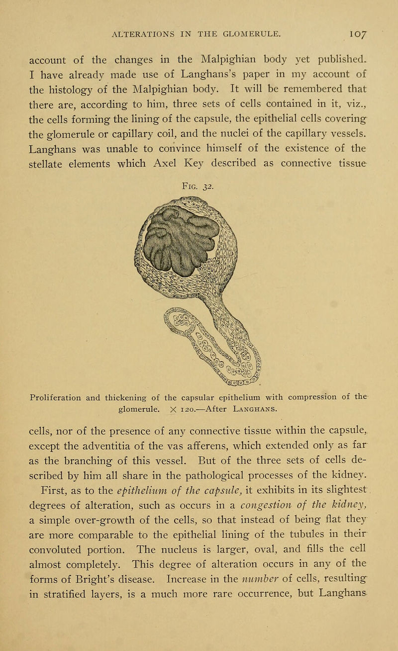 account of the changes in the Malpighian body yet published. I have already made use of Langhans's paper in my account of the histology of the Malpighian body. It will be remembered that there are, according to him, three sets of cells contained in it, viz., the cells forming the lining of the capsule, the epithelial cells covering the glomerule or capillary coil, and the nuclei of the capillary vessels. Langhans was unable to convince himself of the existence of the stellate elements which Axel Key described as connective tissue Fig. 32. Proliferation and thickening of the capsular epithelium with compression of the- glomerule. X 120.—After Langhans. cells, nor of the presence of any connective tissue within the capsule, except the adventitia of the vas afferens, which extended only as far as the branching of this vessel. But of the three sets of cells de- scribed by him all share in the pathological processes of the kidney. First, as to the epithelium of the capsule, it exhibits in its slightest degrees of alteration, such as occurs in a congestion of the kidney, a simple over-growth of the cells, so that instead of being flat they are more comparable to the epithelial lining of the tubules in their convoluted portion. The nucleus is larger, oval, and fills the cell almost completely. This degree of alteration occurs in any of the forms of Bright's disease. Increase in the number of cells, resulting in stratified layers, is a much more rare occurrence, but Langhans