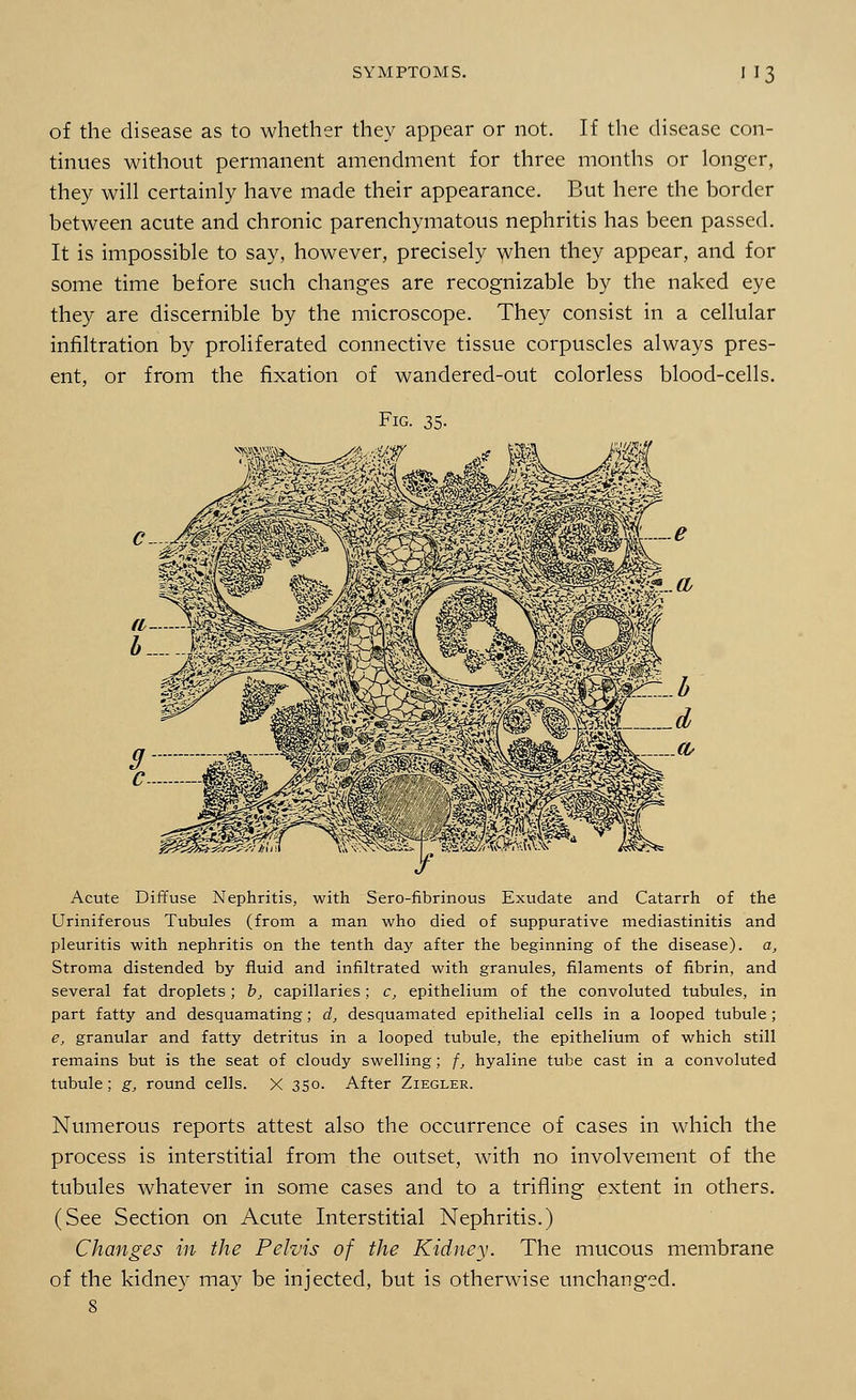 of the disease as to whether they appear or not. If the disease con- tinues without permanent amendment for three months or longer, they will certainly have made their appearance. But here the border between acute and chronic parenchymatous nephritis has been passed. It is impossible to say, however, precisely when they appear, and for some time before such changes are recognizable by the naked eye they are discernible by the microscope. They consist in a cellular infiltration by proliferated connective tissue corpuscles always pres- ent, or from the fixation of wandered-out colorless blood-cells. Fig. 35. Acute Diffuse Nephritis, with Sero-fibrinous Exudate and Catarrh of the Uriniferous Tubules (from a man who died of suppurative mediastinitis and pleuritis with nephritis on the tenth day after the beginning of the disease), a, Stroma distended by fluid and infiltrated with granules, filaments of fibrin, and several fat droplets; b, capillaries; c, epithelium of the convoluted tubules, in part fatty and desquamating; d, desquamated epithelial cells in a looped tubule ; e, granular and fatty detritus in a looped tubule, the epithelium of which still remains but is the seat of cloudy swelling; f, hyaline tube cast in a convoluted tubule; g, round cells. X 350. After Ziegler. Numerous reports attest also the occurrence of cases in which the process is interstitial from the outset, with no involvement of the tubules whatever in some cases and to a trifling extent in others. (See Section on Acute Interstitial Nephritis.) Changes in the Pelvis of the Kidney. The mucous membrane of the kidney may be injected, but is otherwise unchanged. 8