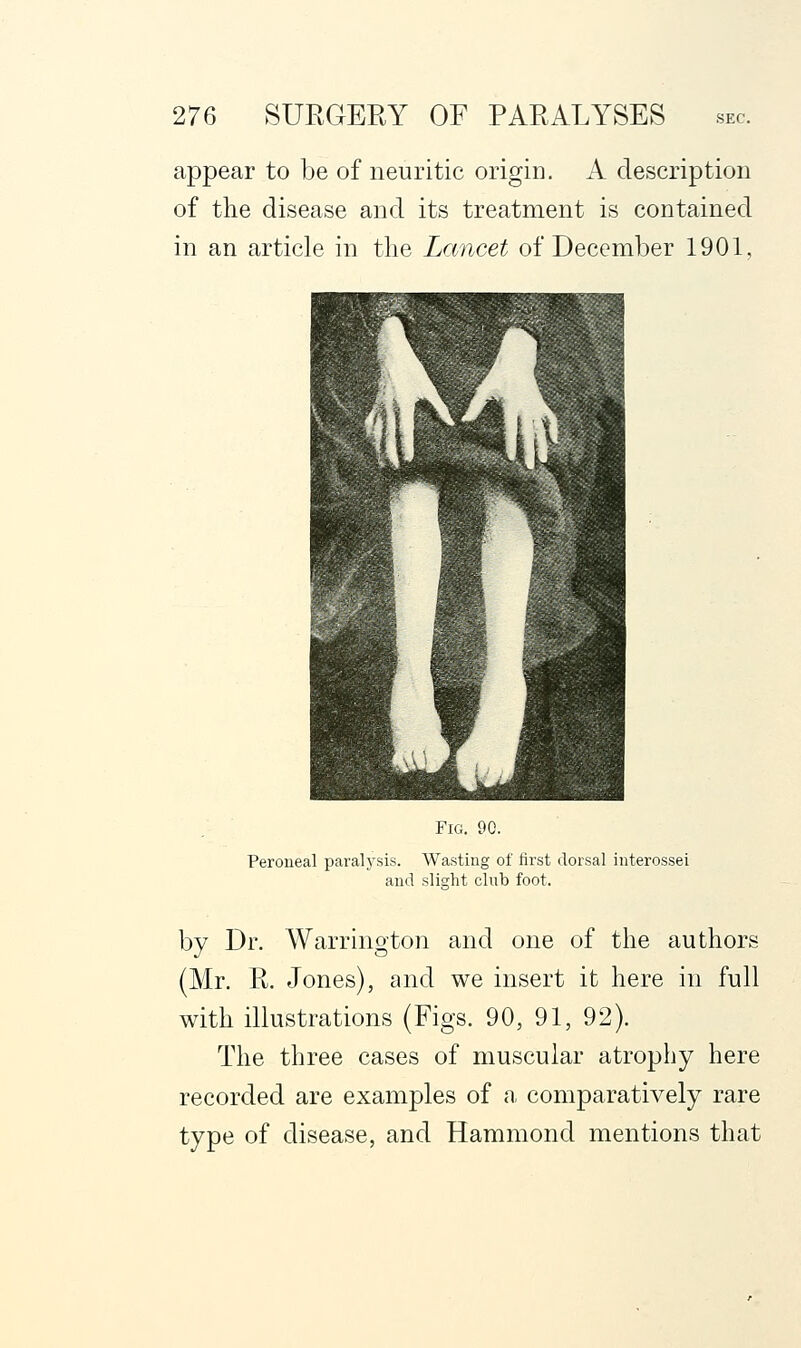 appear to be of neuritic origin. A description of the disease and its treatment is contained in an article in the Lancet of December 1901, Fig. 90. Peroneal paralysis. Wasting of first dorsal interossei and slisrht club foot. by Dr. Warrington and one of the authors (Mr. R. Jones), and we insert it here in full with illustrations (Figs. 90, 91, 92). The three cases of muscular atrophy here recorded are examples of a comparatively rare type of disease, and Hammond mentions that