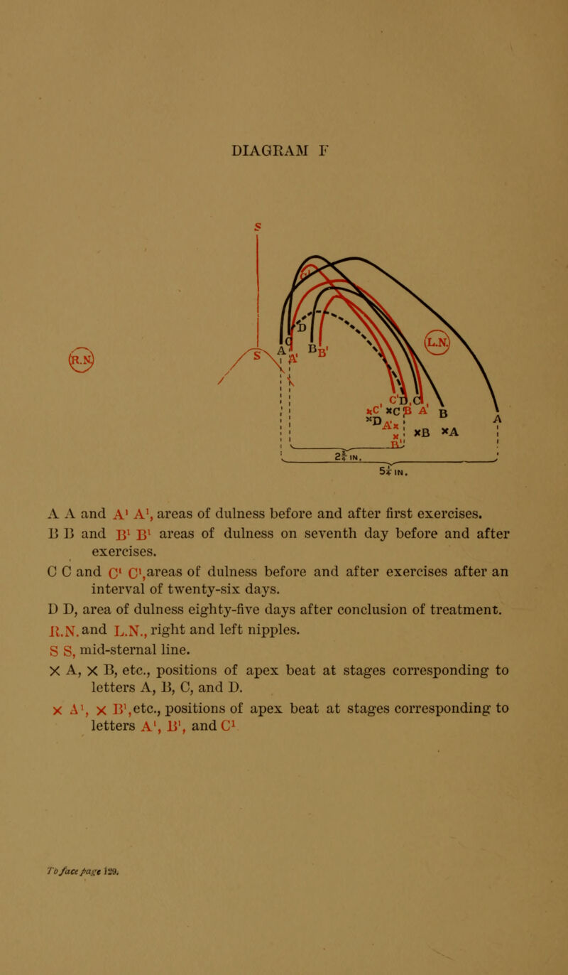 A A and A1 A1, areas of dulness before and after first exercises. 13 B and B1 Bl areas of dulness on seventh day before and after exercises. C C and Cl C'^reas of dulness before and after exercises after an interval of twenty-six days. D D, area of dulness eighty-five days after conclusion of treatment. K.N. and L.N., right and left nipples. S S, mid-sternal line. X A, X B, etc., positions of apex beat at stages corresponding to letters A, B, C, and D. x A1, x B^etc, positions of apex beat at stages corresponding to letters A1, B1, andC1